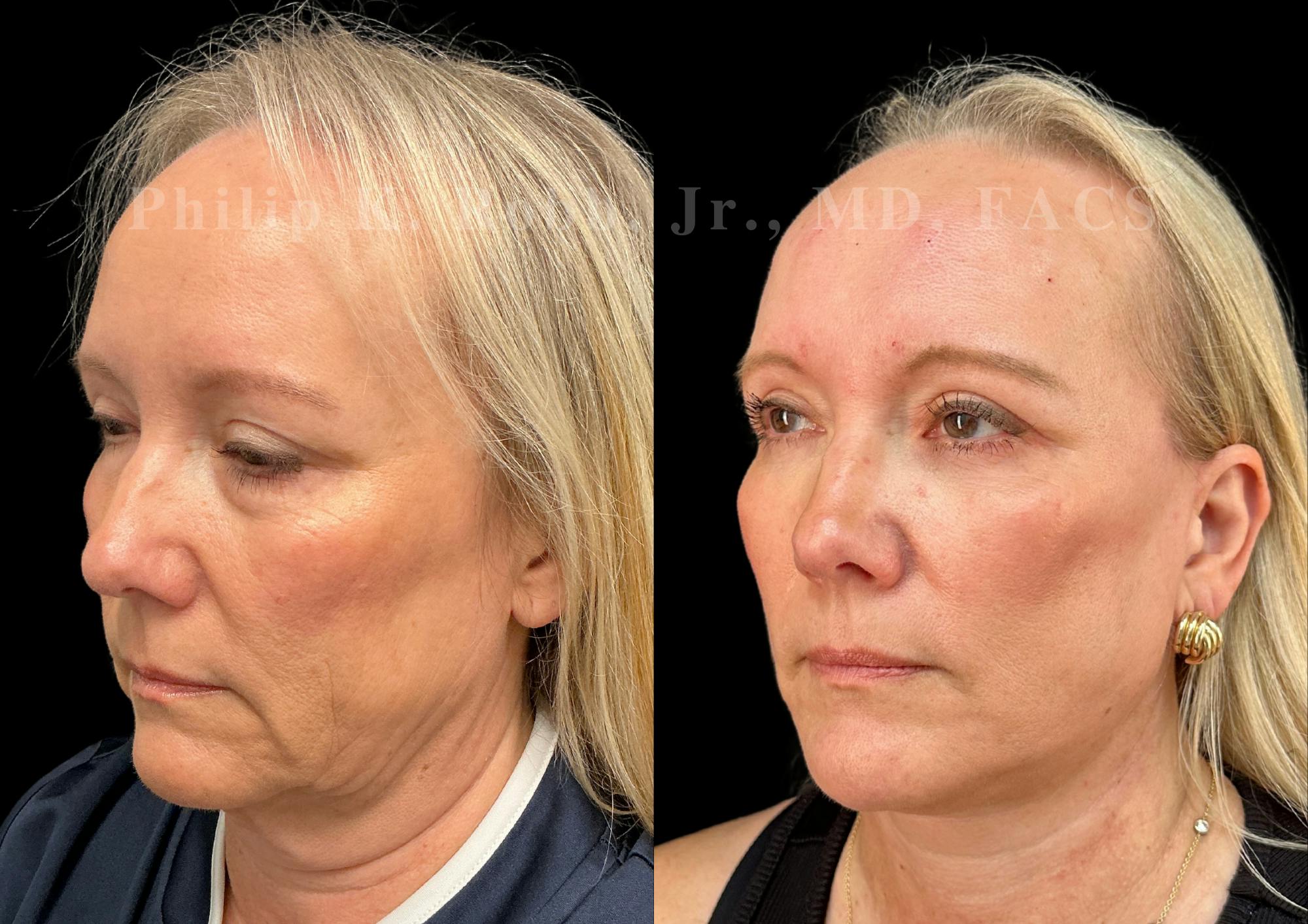 Neck Lift Before & After Gallery - Patient 707661 - Image 3