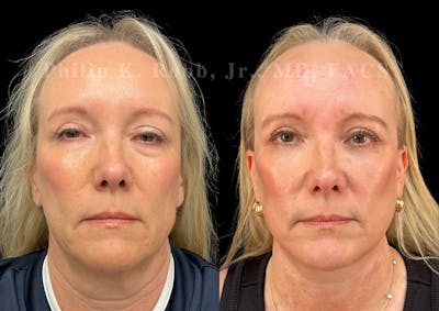 Fat Transfer Before & After Gallery - Patient 259726 - Image 1