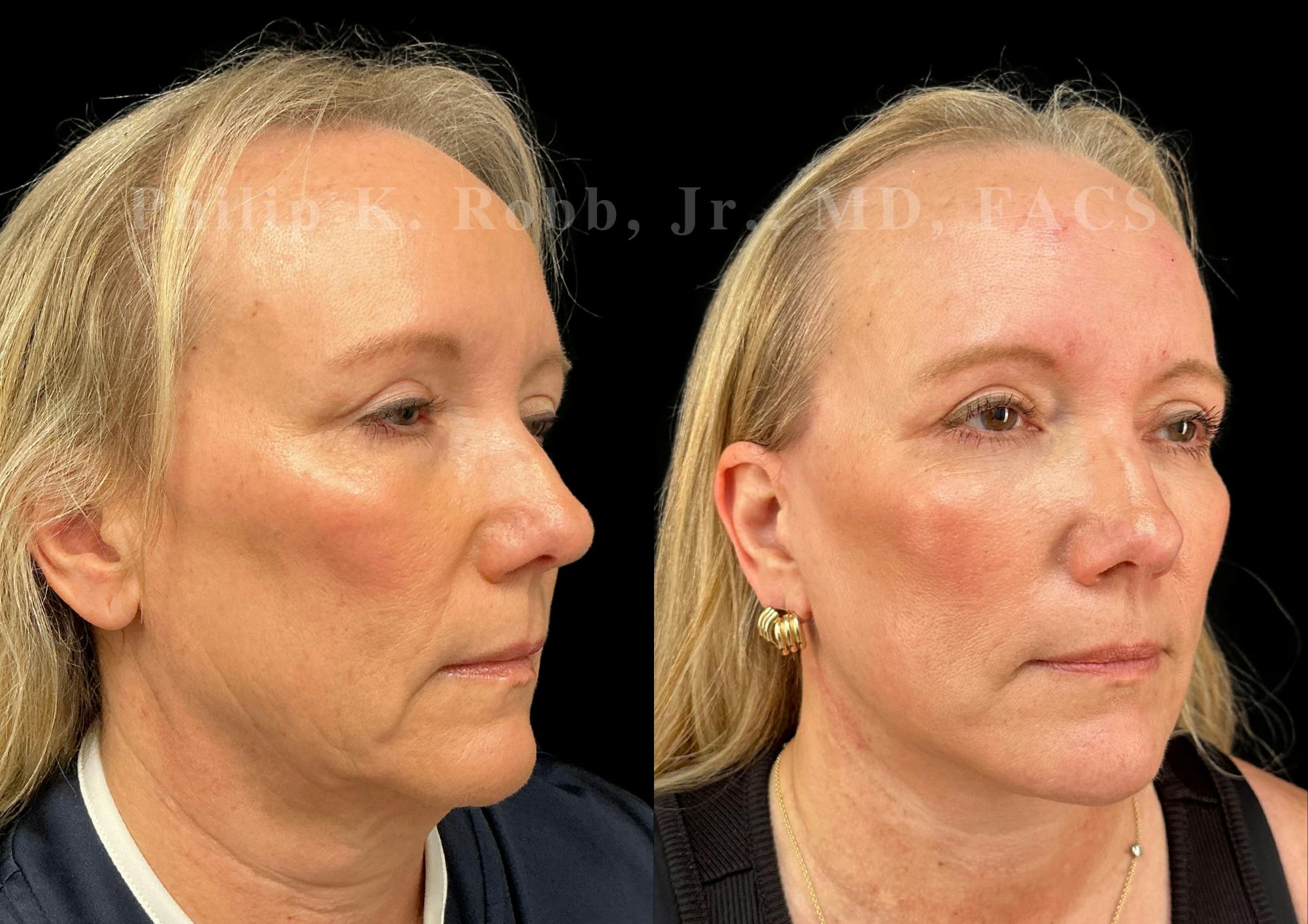 Neck Lift Before & After Gallery - Patient 707661 - Image 5