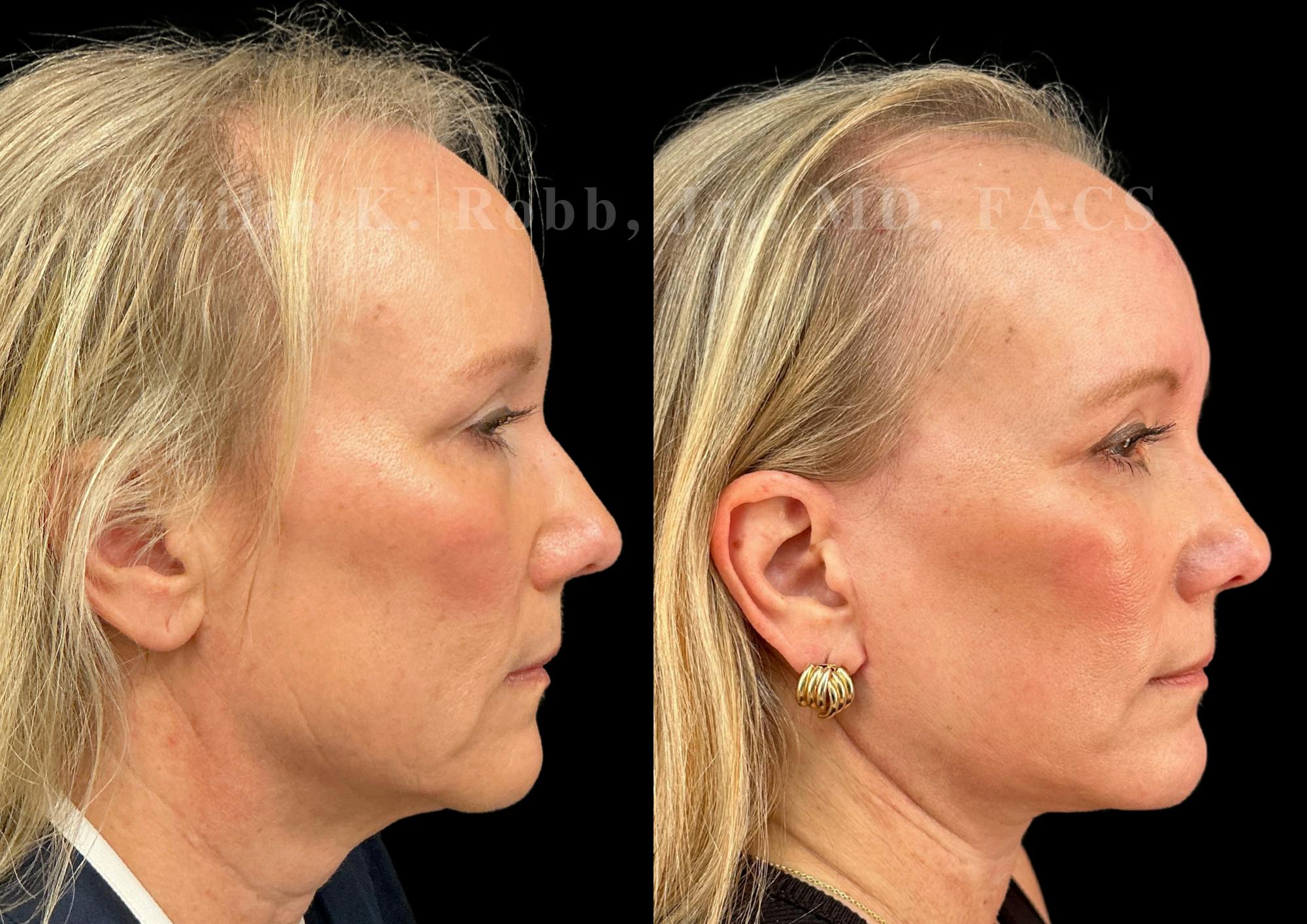 Neck Lift Before & After Gallery - Patient 707661 - Image 6