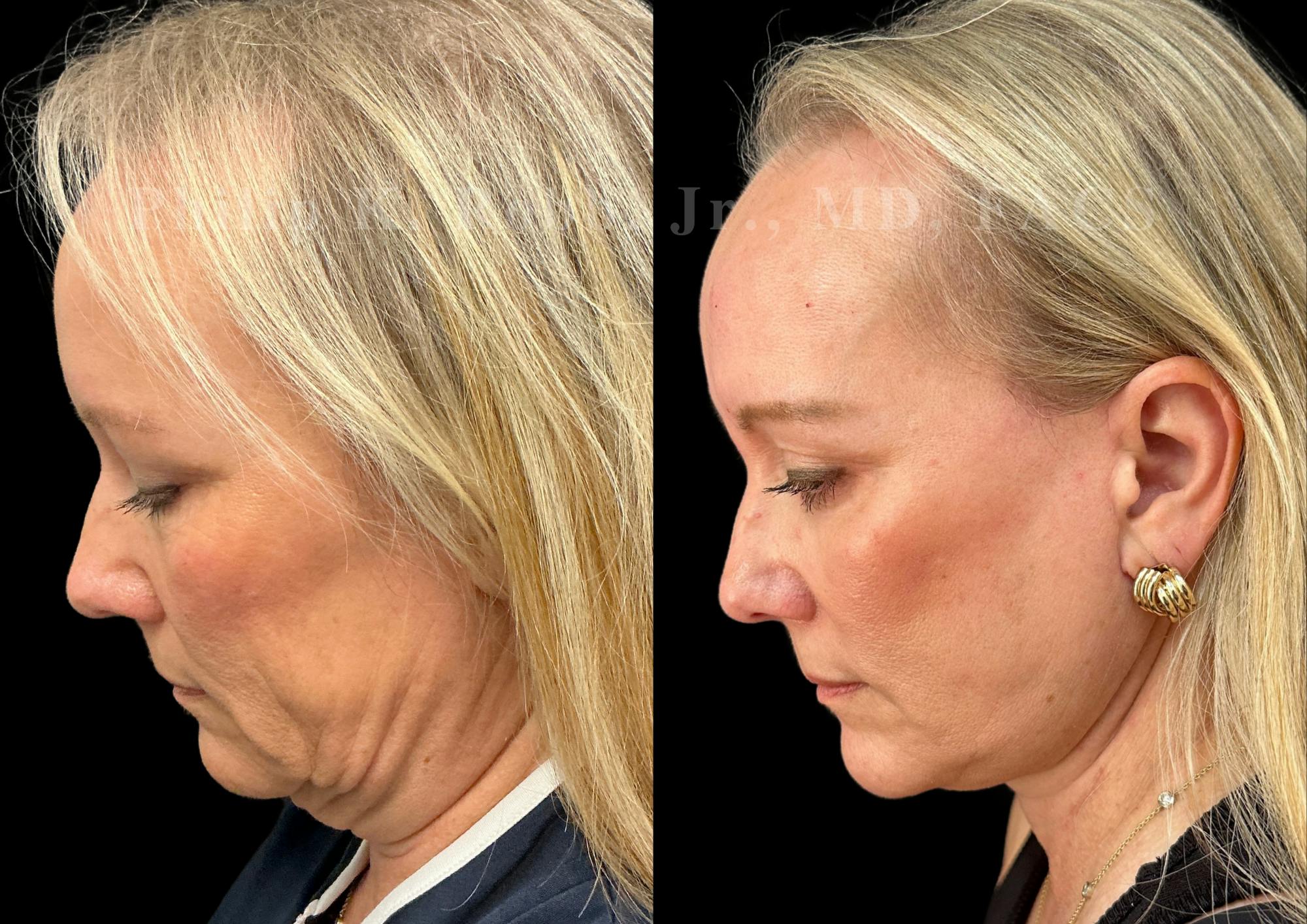 Neck Lift Before & After Gallery - Patient 707661 - Image 2