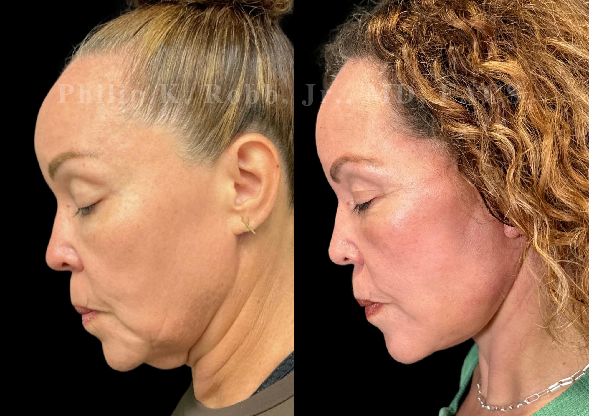 Neck Lift Before & After Gallery - Patient 211665 - Image 2