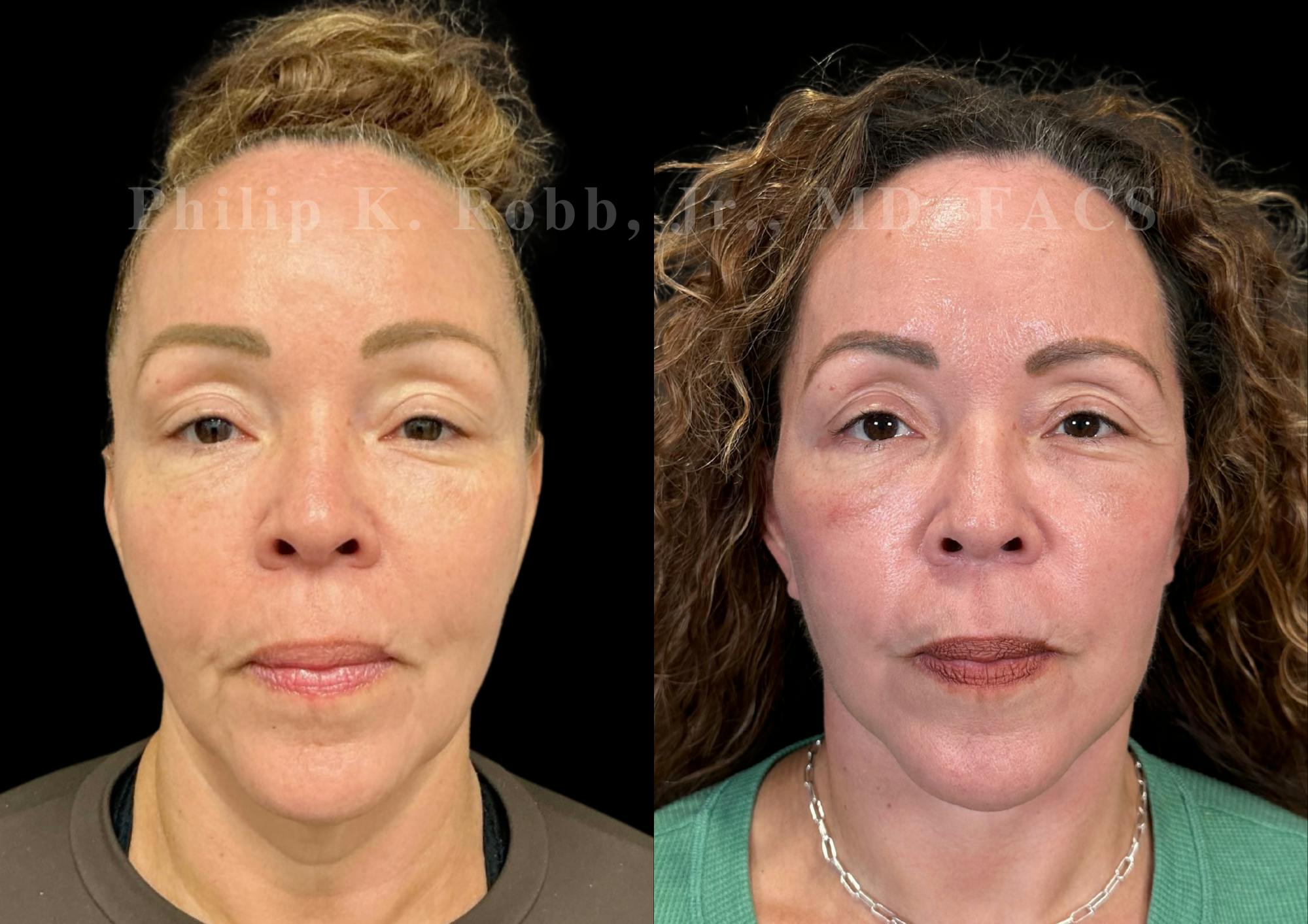 Neck Lift Before & After Gallery - Patient 211665 - Image 4