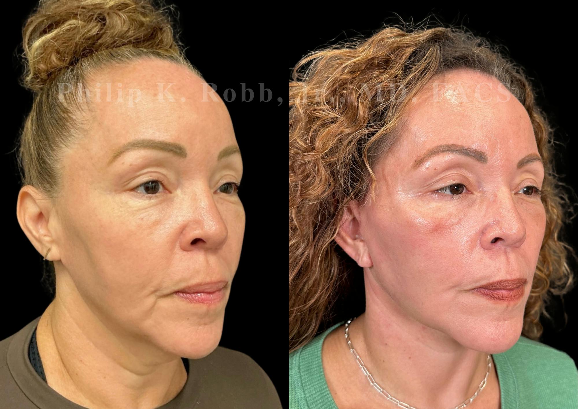 Neck Lift Before & After Gallery - Patient 211665 - Image 5
