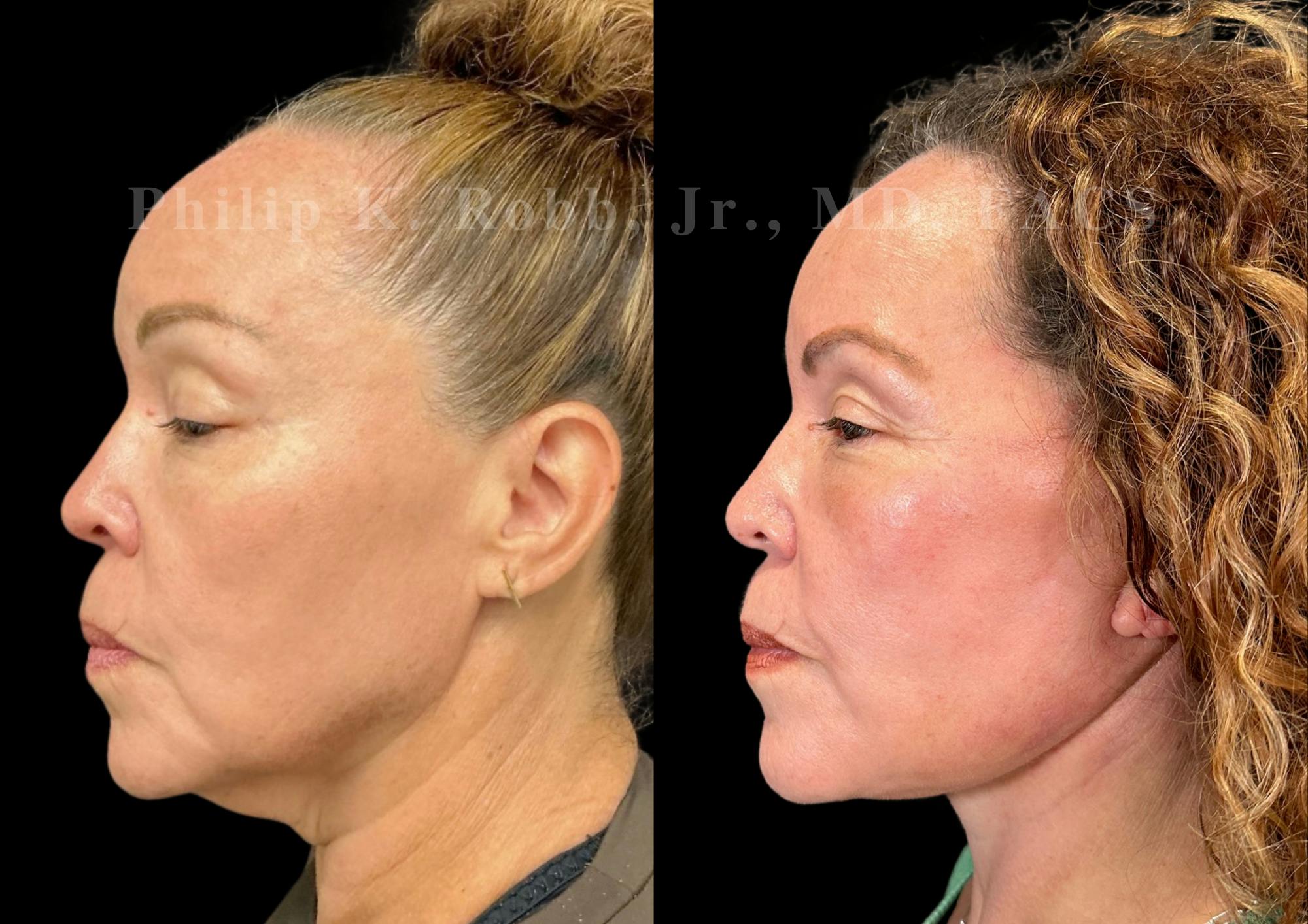 Neck Lift Before & After Gallery - Patient 211665 - Image 1
