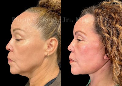 Neck Lift Before & After Gallery - Patient 211665 - Image 1