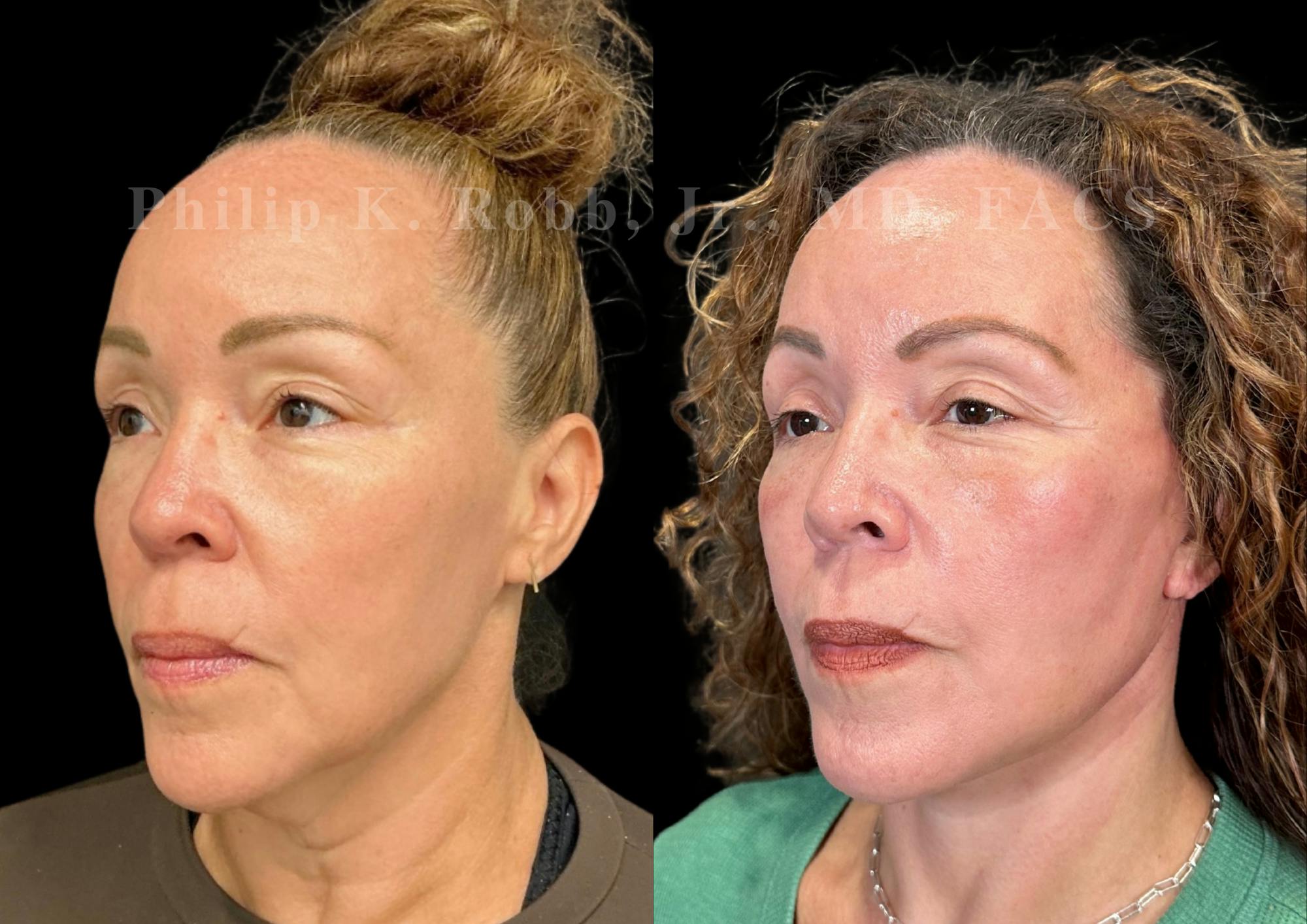Neck Lift Before & After Gallery - Patient 211665 - Image 3