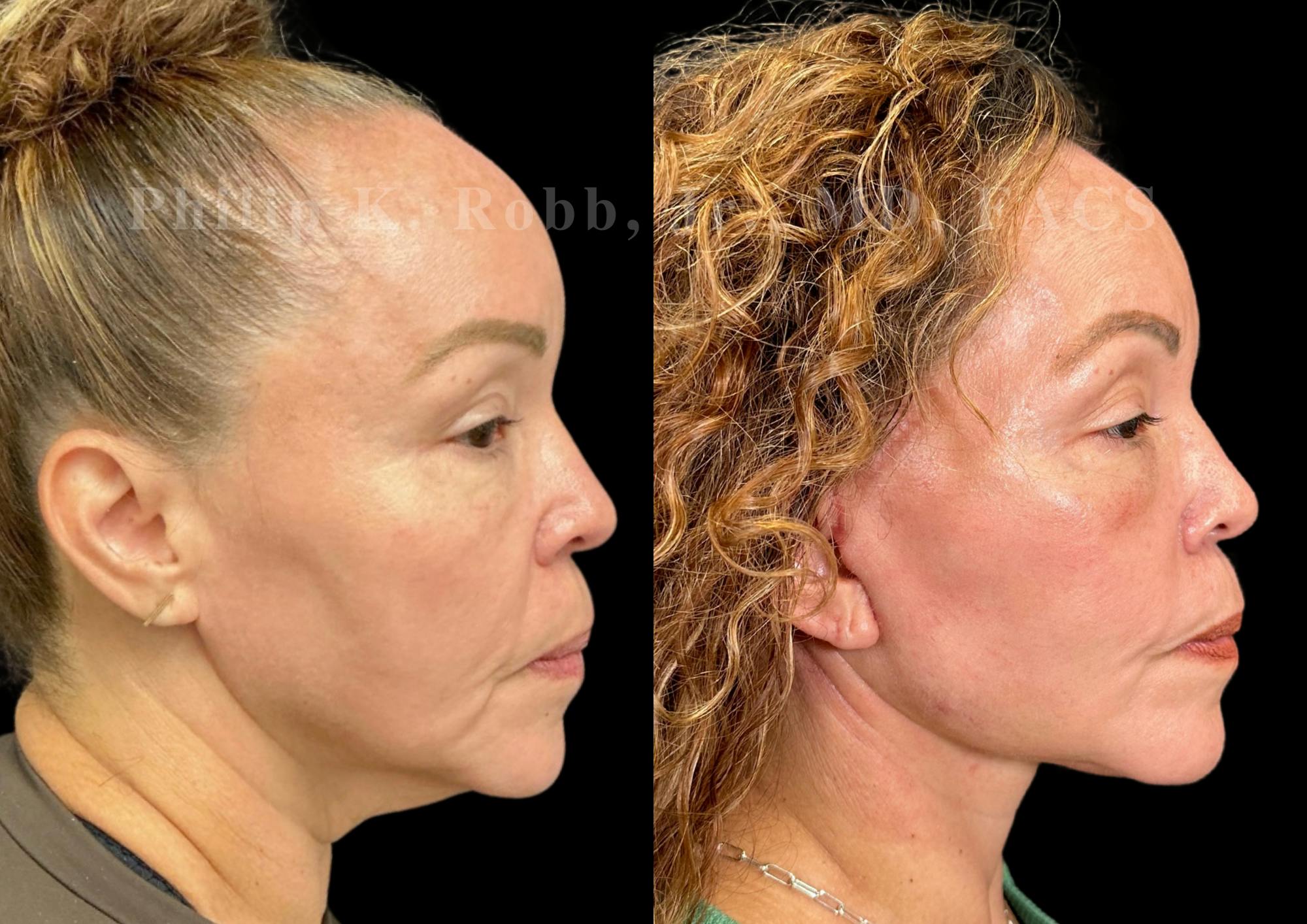 Neck Lift Before & After Gallery - Patient 211665 - Image 6