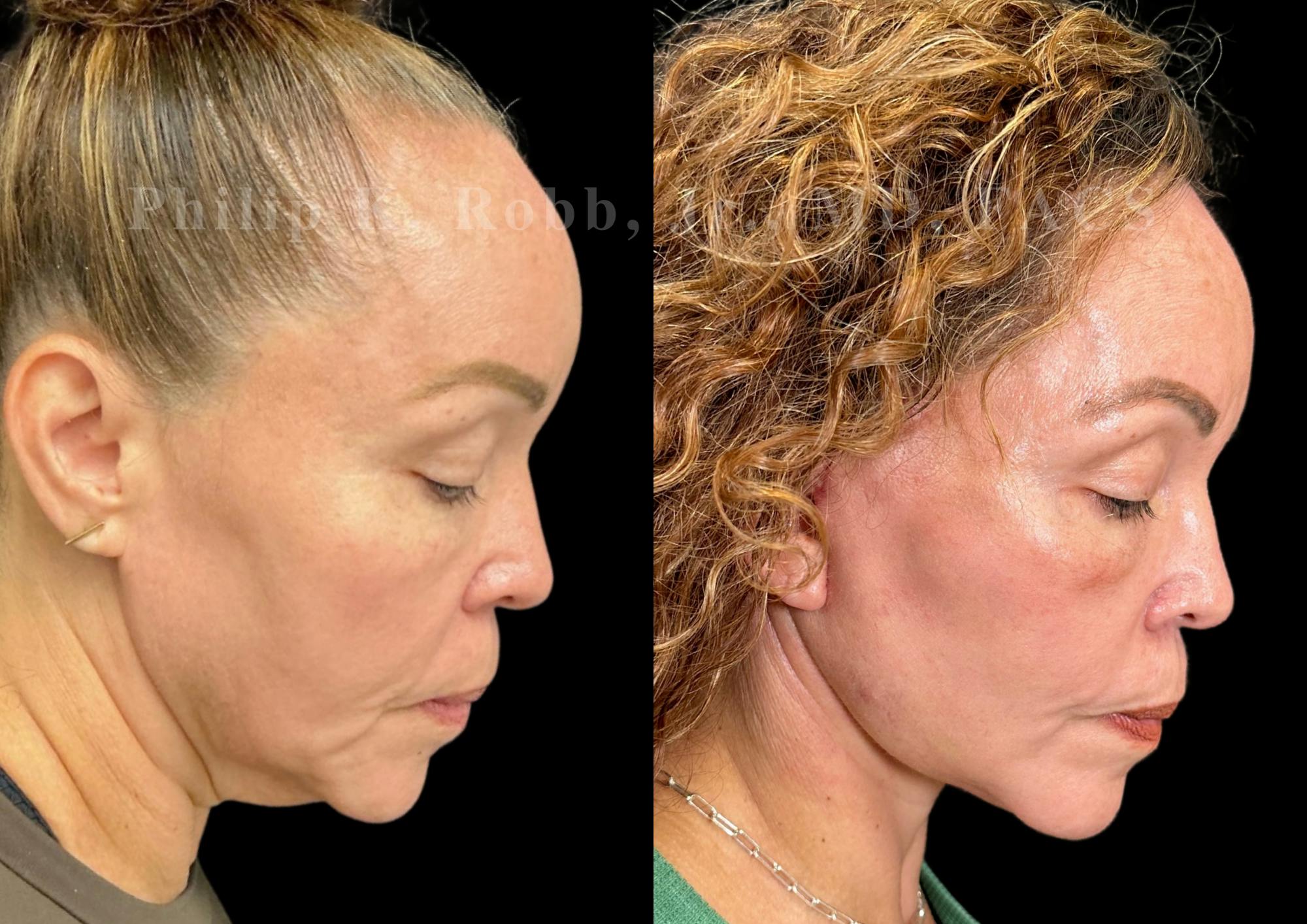 Neck Lift Before & After Gallery - Patient 211665 - Image 7