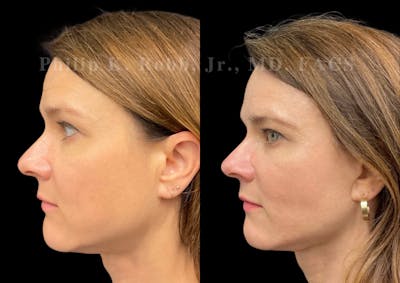 Neck Lift Before & After Gallery - Patient 206007 - Image 1