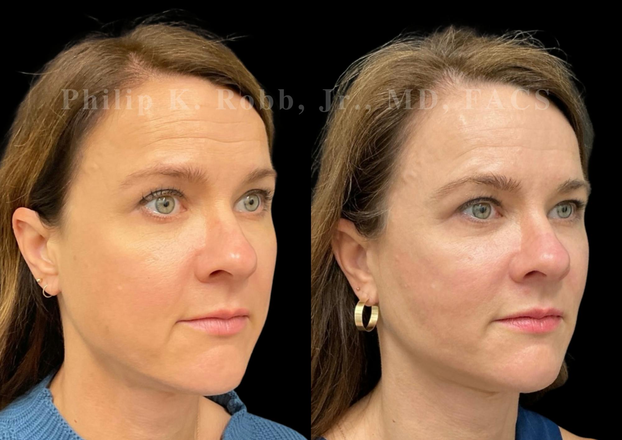 Neck Lift Before & After Gallery - Patient 206007 - Image 5