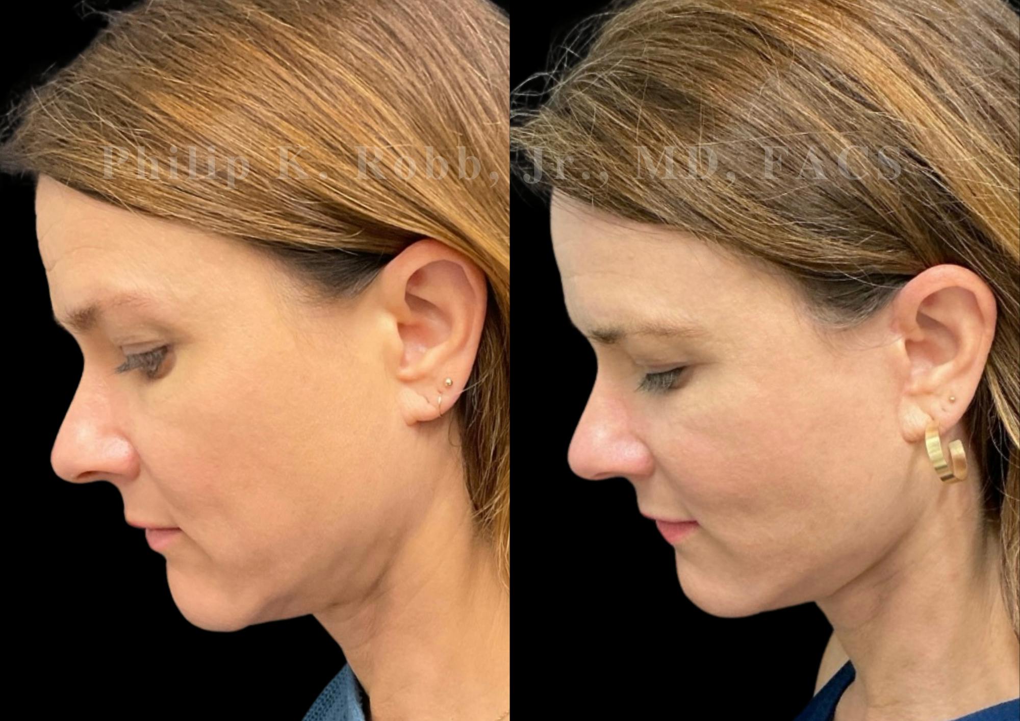 Neck Lift Before & After Gallery - Patient 206007 - Image 2
