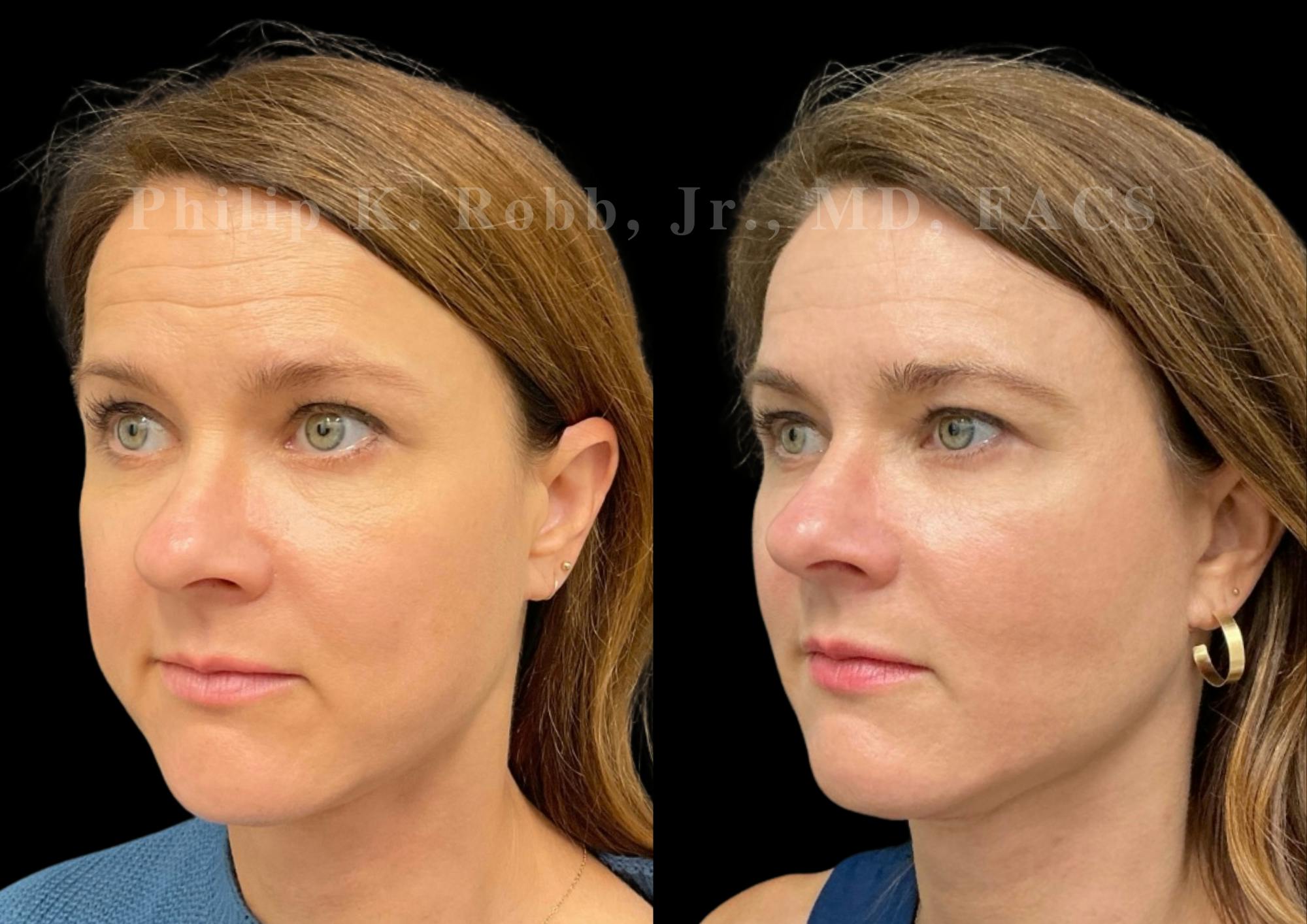 Neck Lift Before & After Gallery - Patient 206007 - Image 3