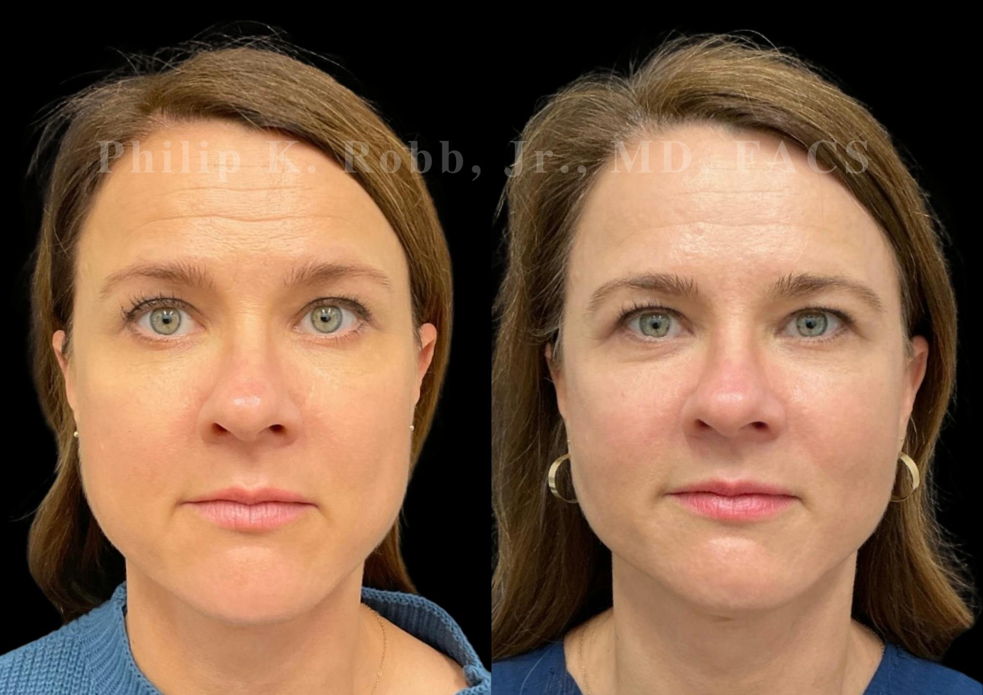 Neck Lift Before & After Gallery - Patient 206007 - Image 4