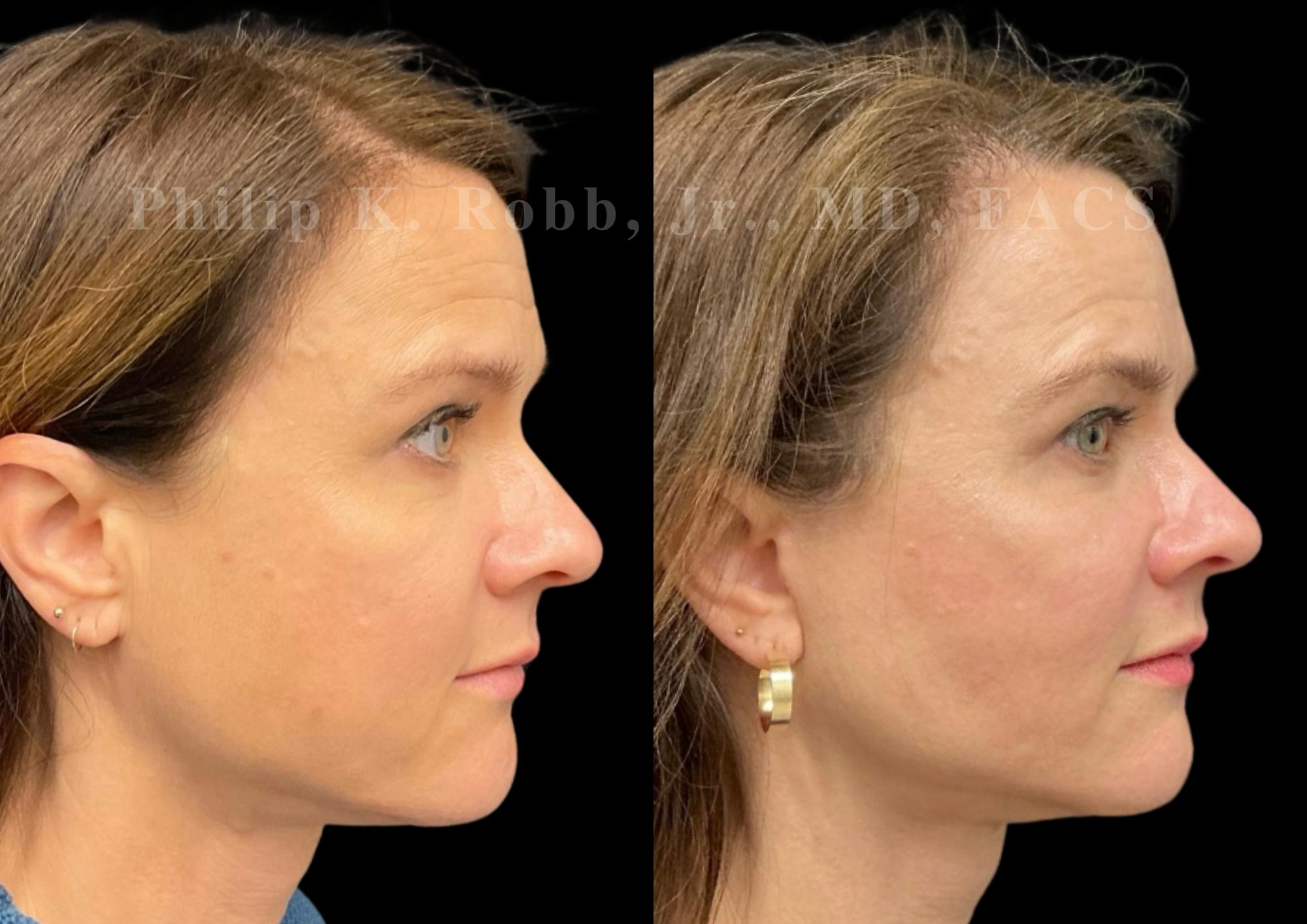 Neck Lift Before & After Gallery - Patient 206007 - Image 6