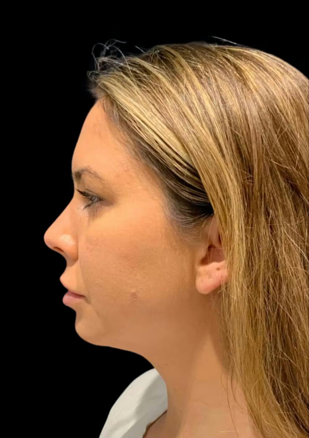 chin augmentation procedure