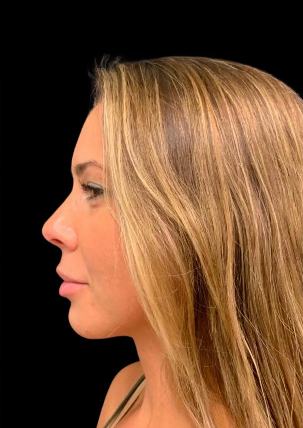 chin augmentation procedure