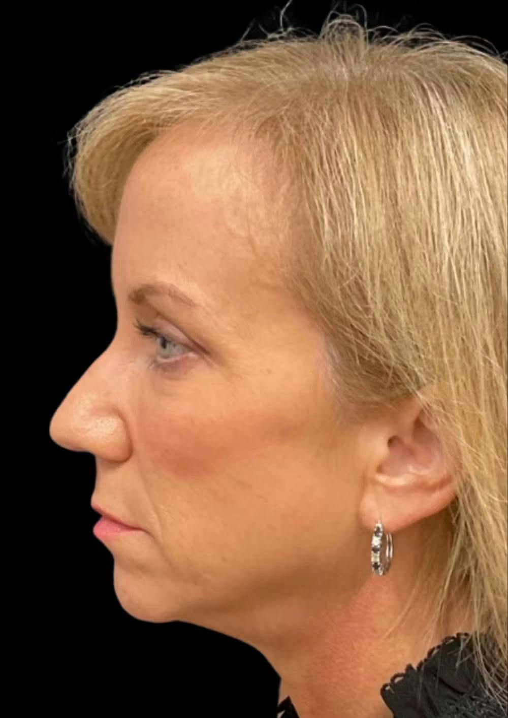 before and after chin augmentation