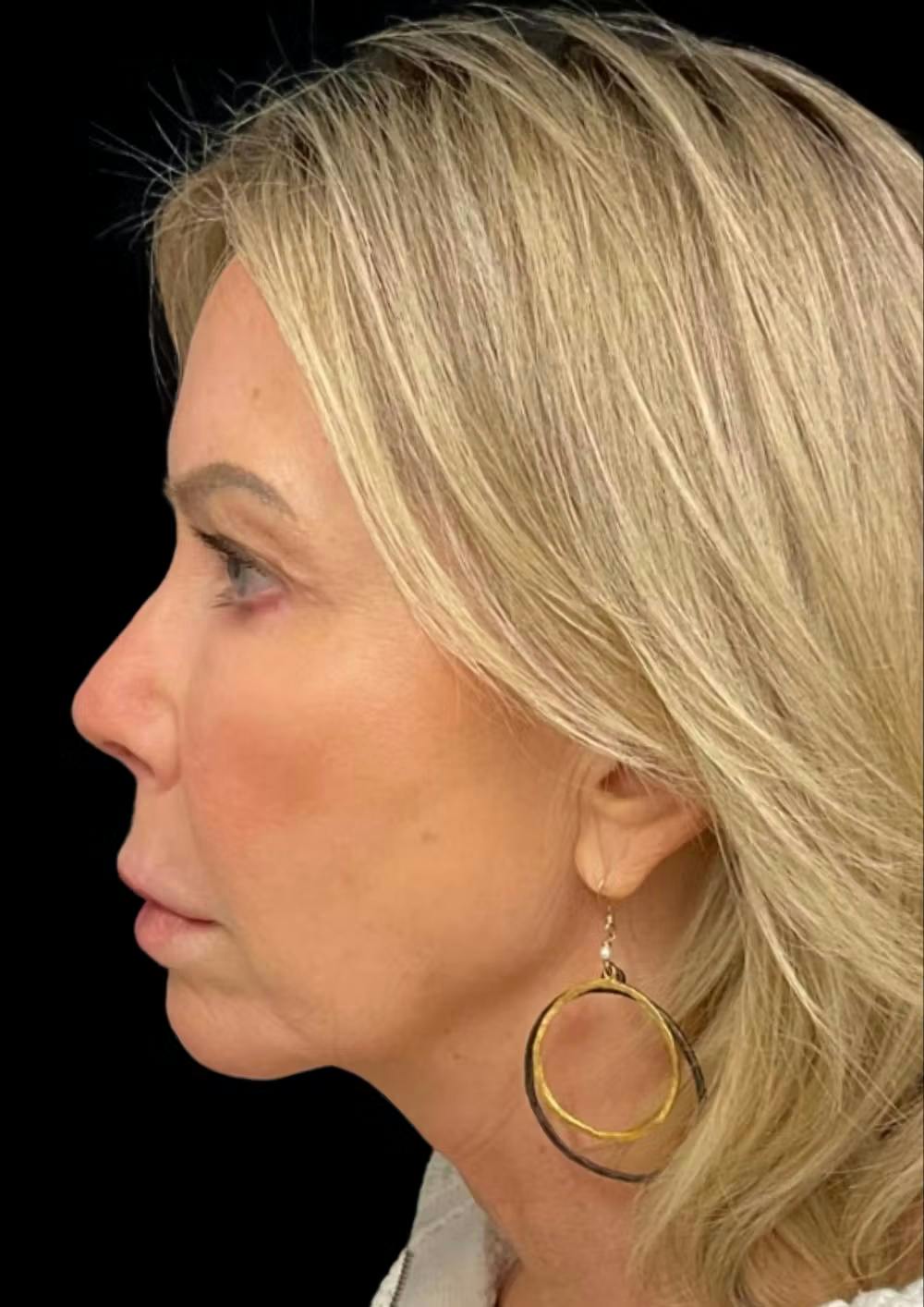 chin augmentation surgery before and after