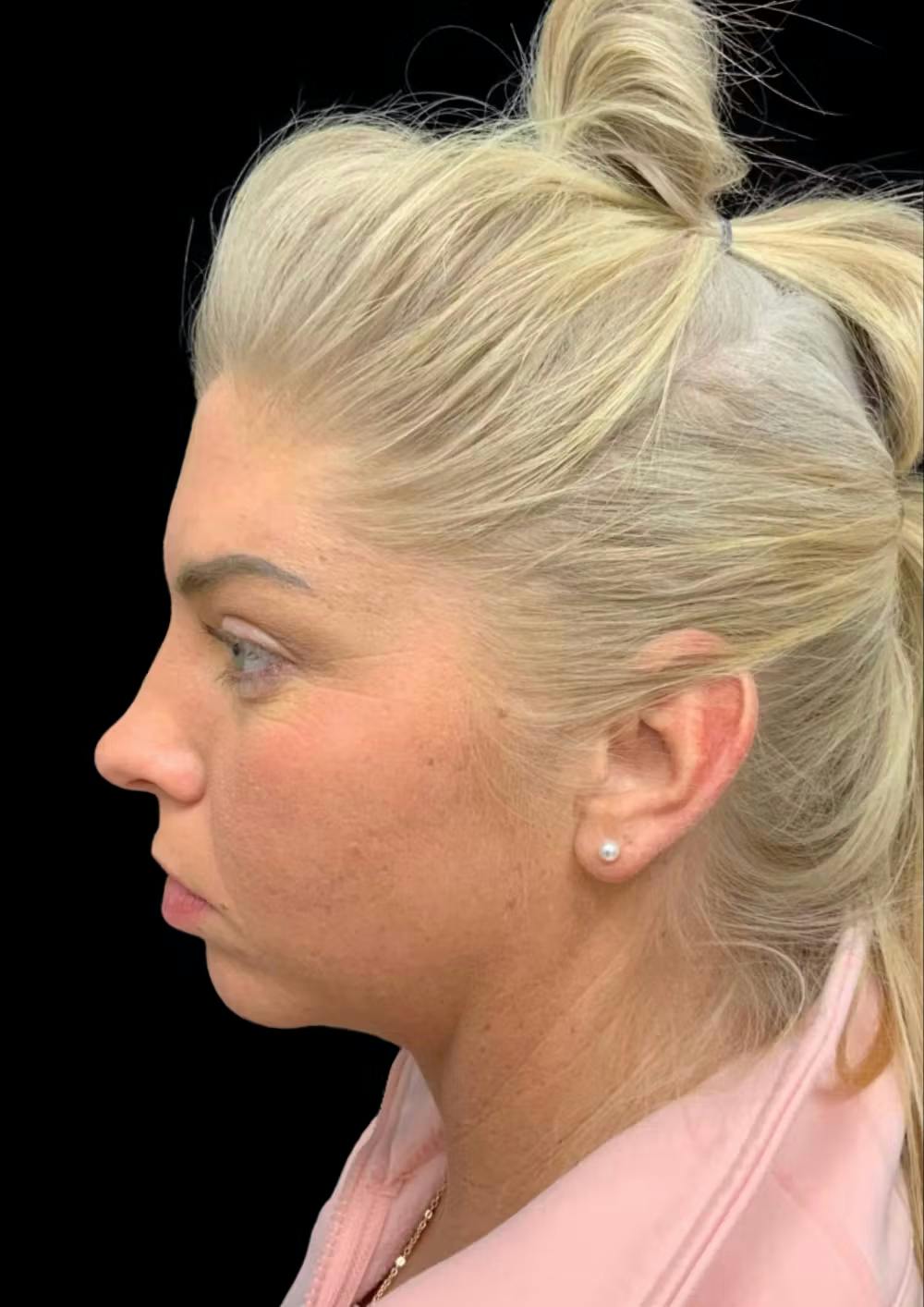chin augmentation before and after photos