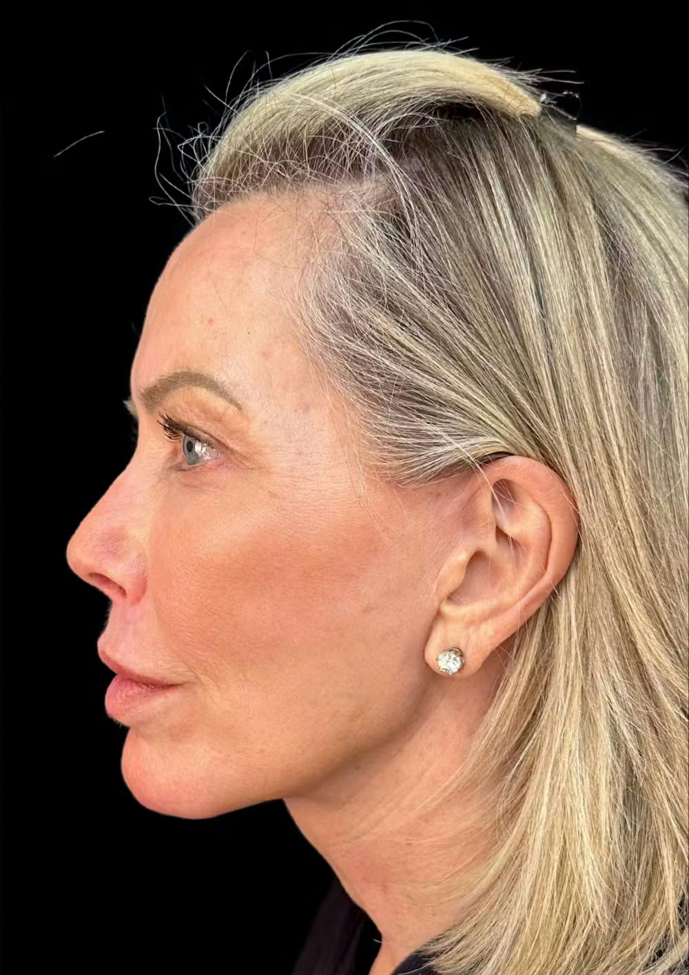 chin augmentation surgery before and after