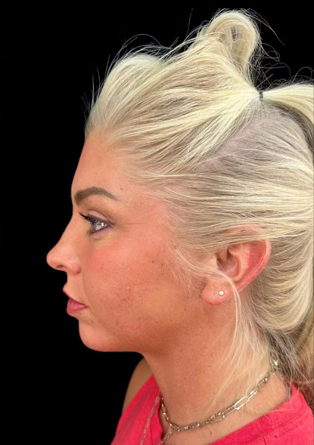 chin augmentation before and after photos