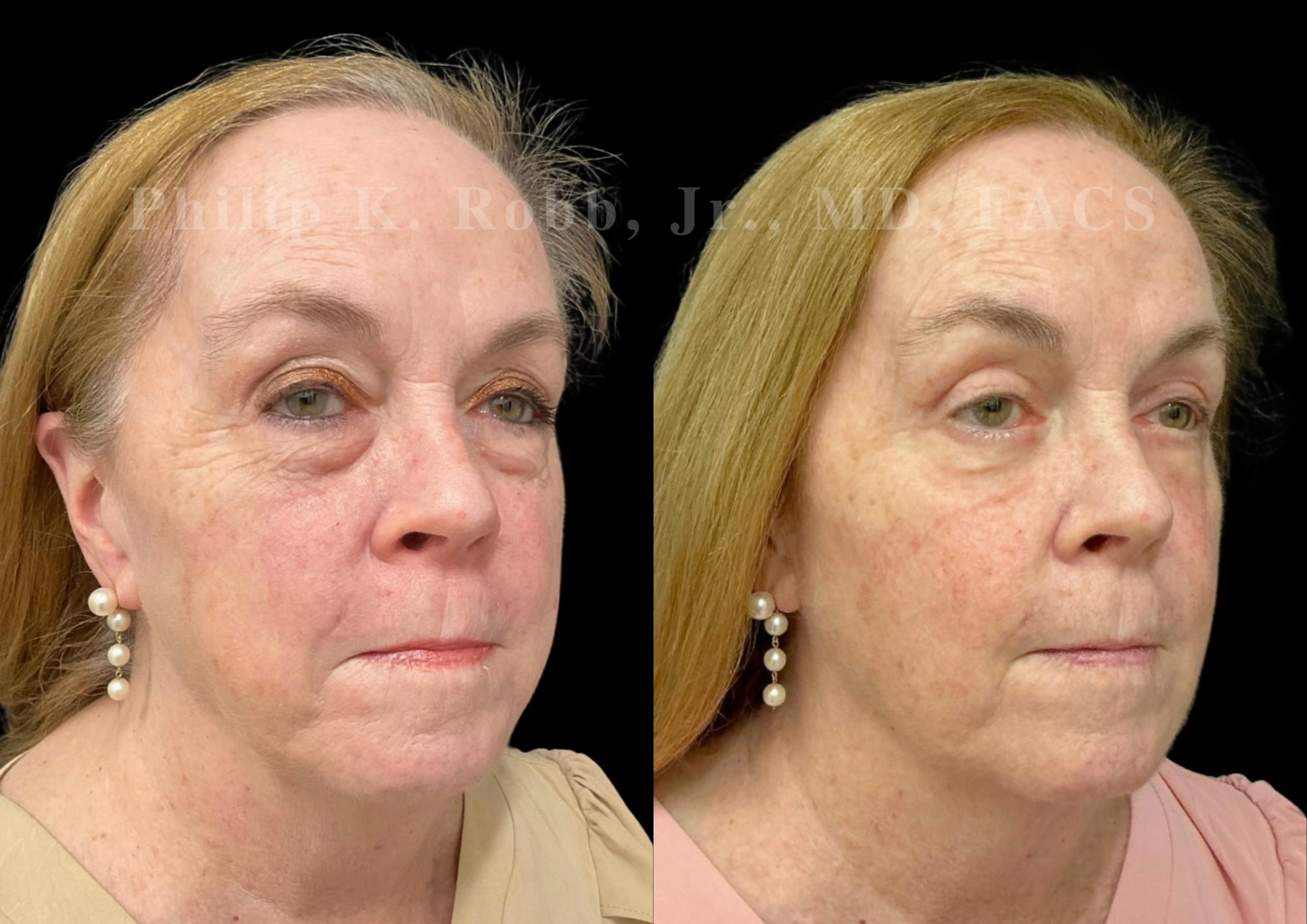 Laser Skin Resurfacing Before & After Gallery - Patient 307121 - Image 3