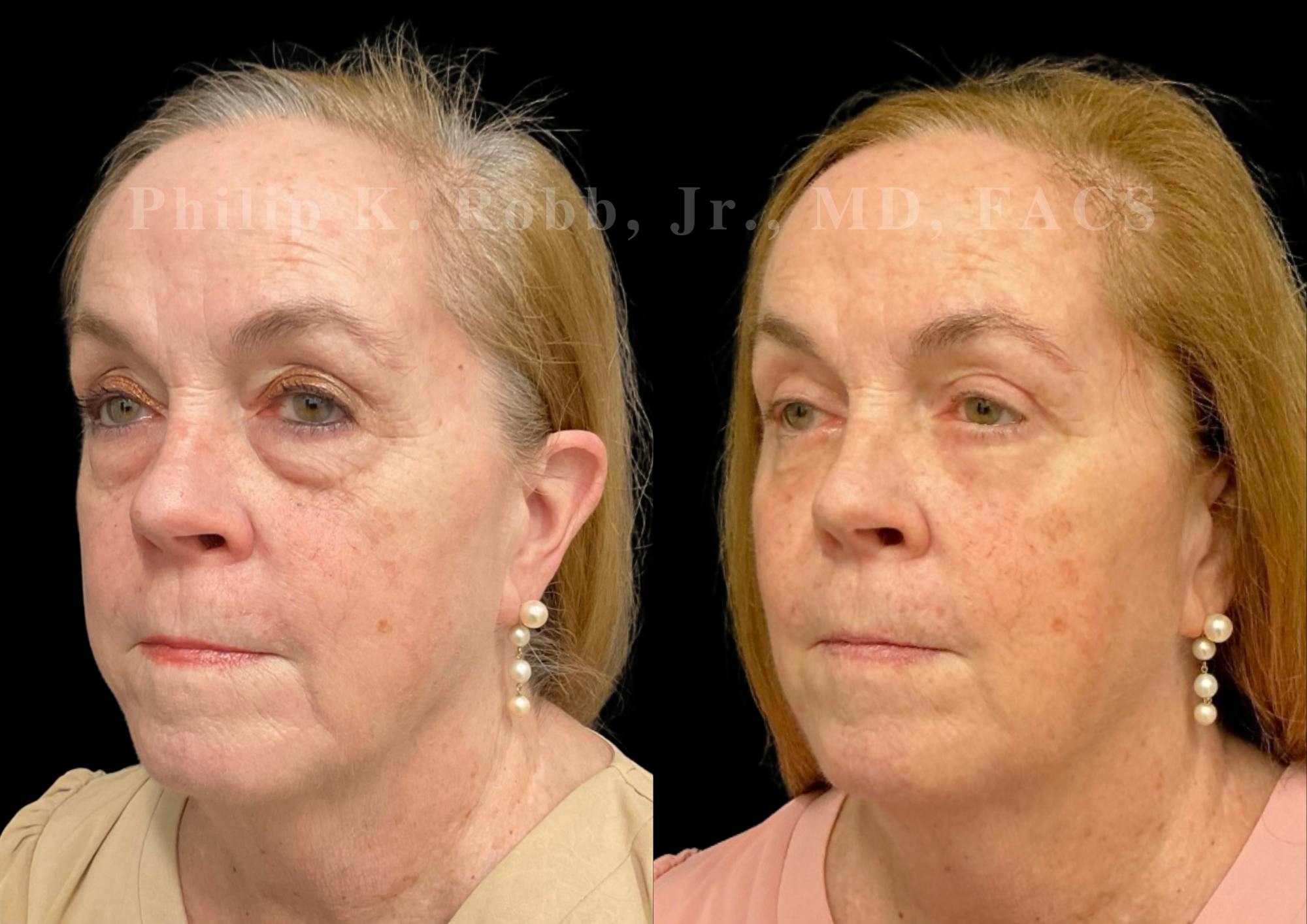 Laser Skin Resurfacing Before & After Gallery - Patient 307121 - Image 2