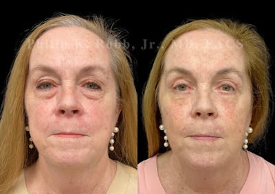 Laser Skin Resurfacing Before & After Gallery - Patient 307121 - Image 1