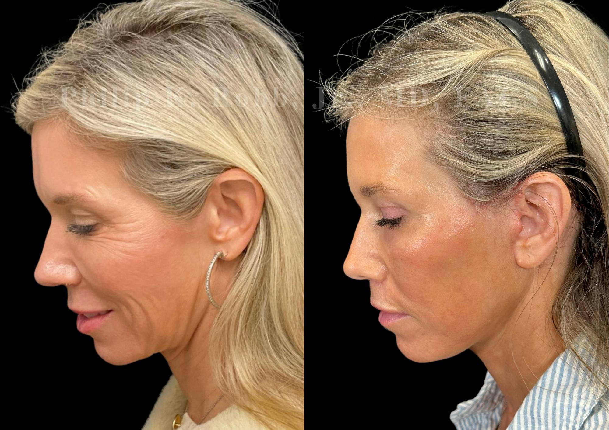 Facelift Before & After Gallery - Patient 397795 - Image 2