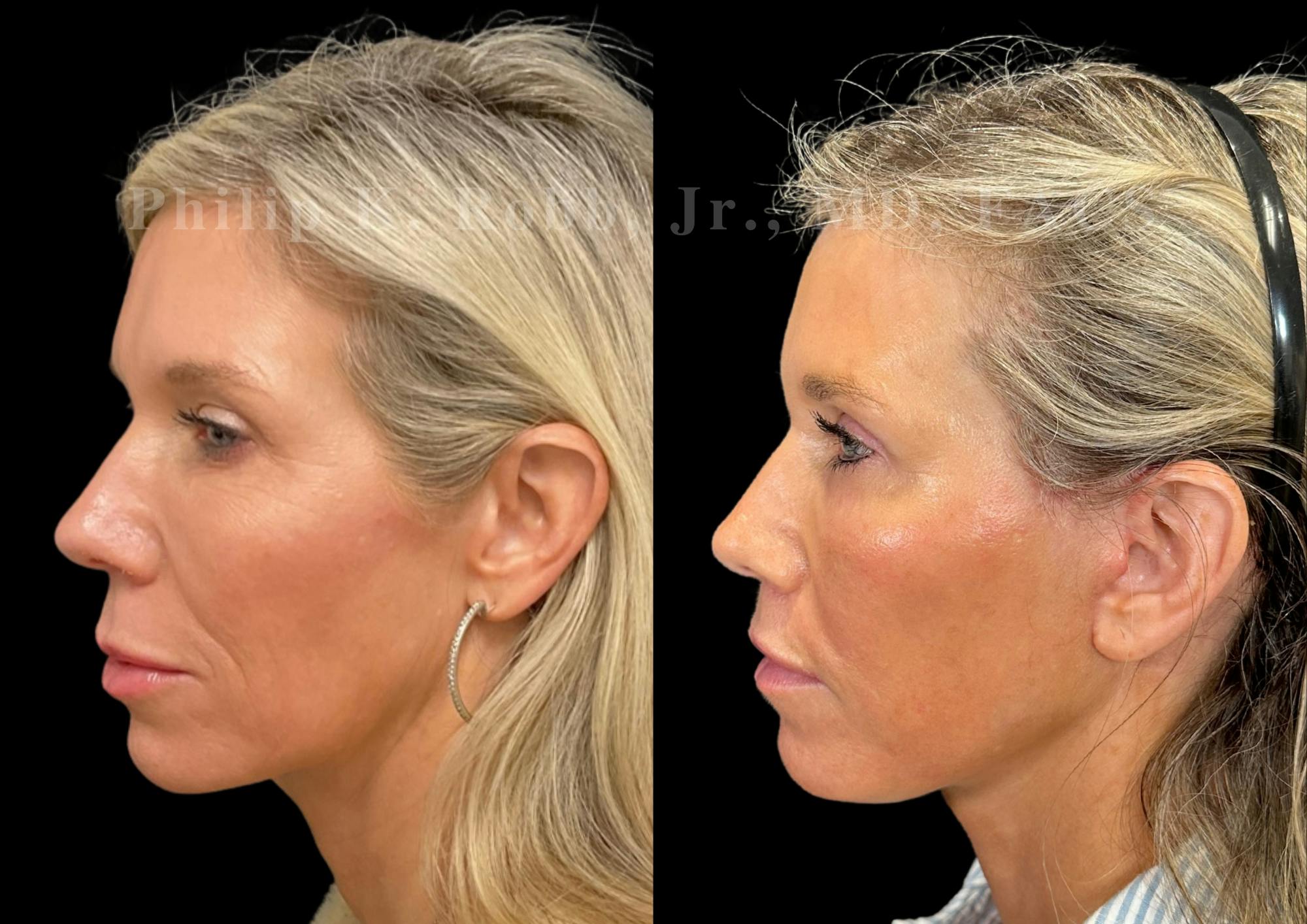 Facelift Before & After Gallery - Patient 397795 - Image 3