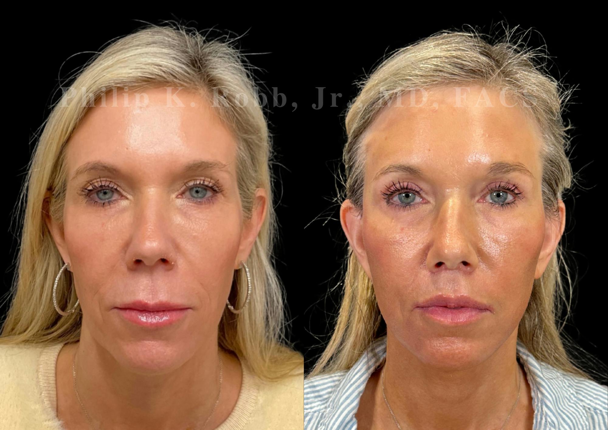 Facelift Before & After Gallery - Patient 397795 - Image 4