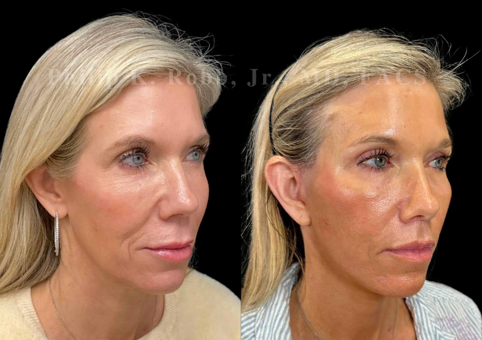 Facelift Before & After Gallery - Patient 397795 - Image 5