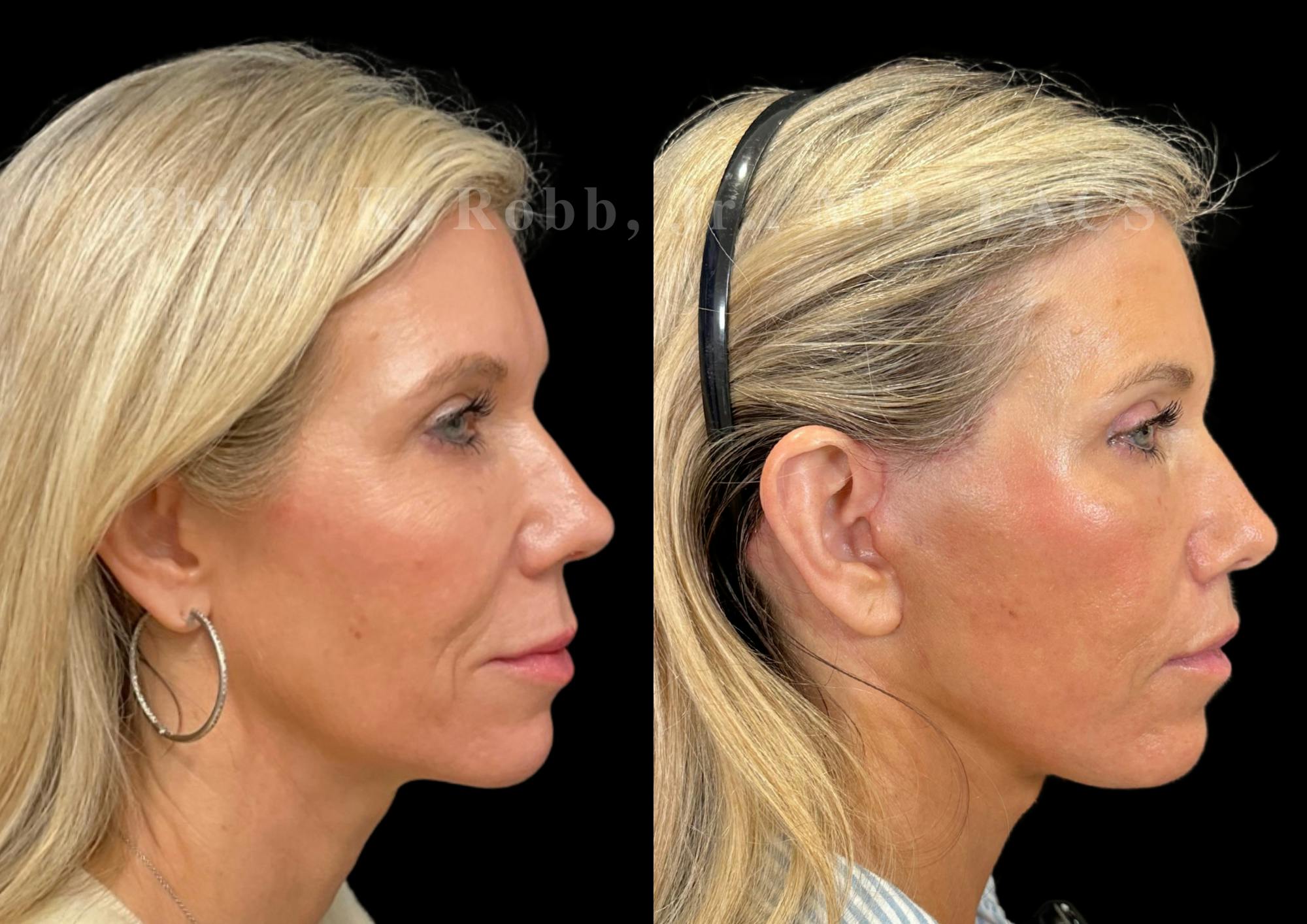 Facelift Before & After Gallery - Patient 397795 - Image 6