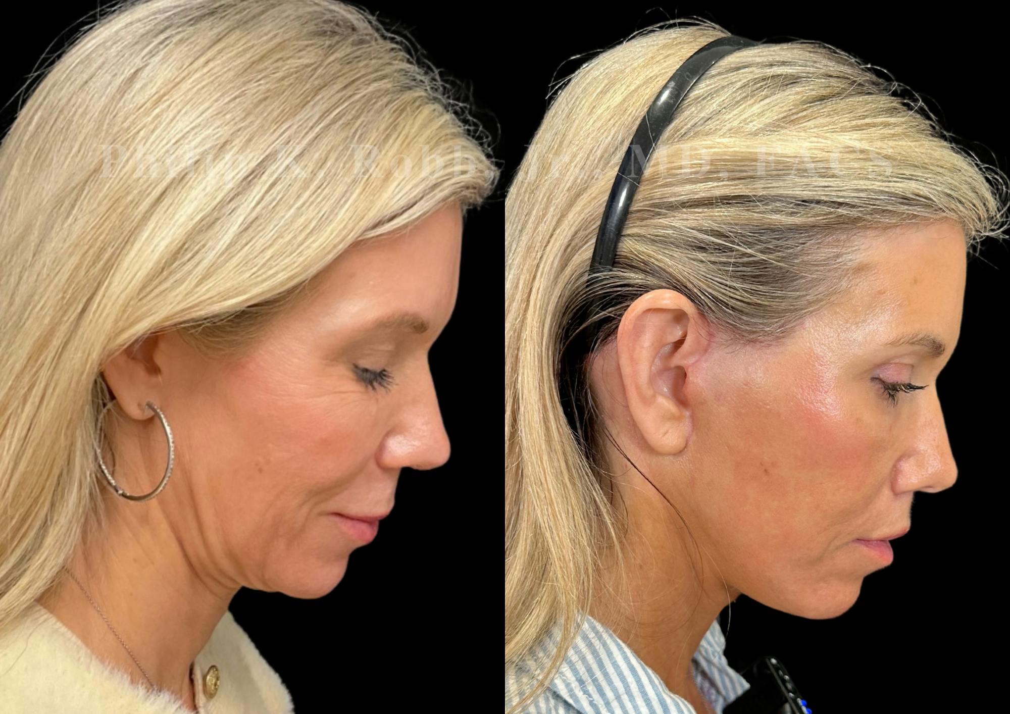 Facelift Before & After Gallery - Patient 397795 - Image 7
