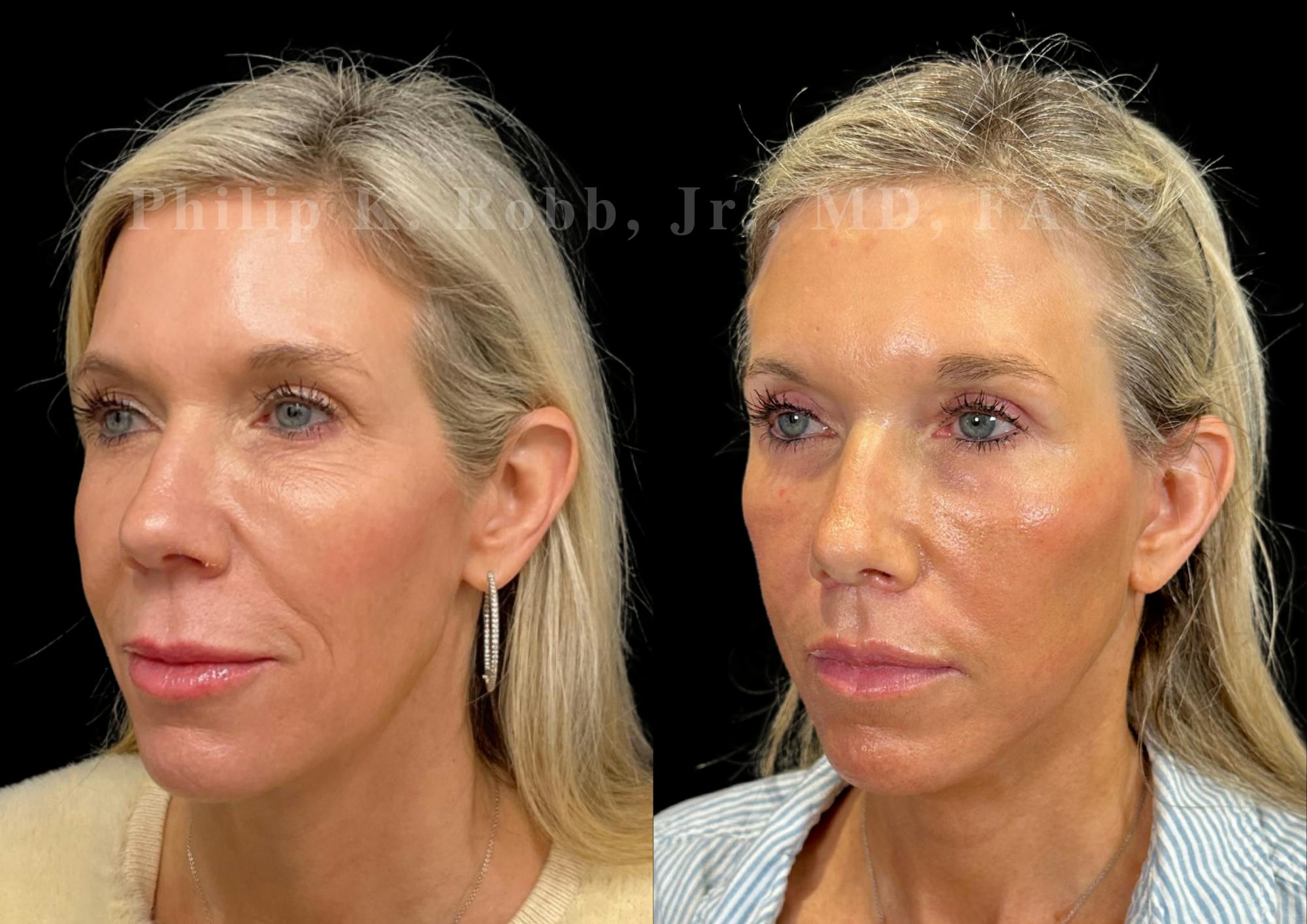 Facelift Before & After Gallery - Patient 397795 - Image 1