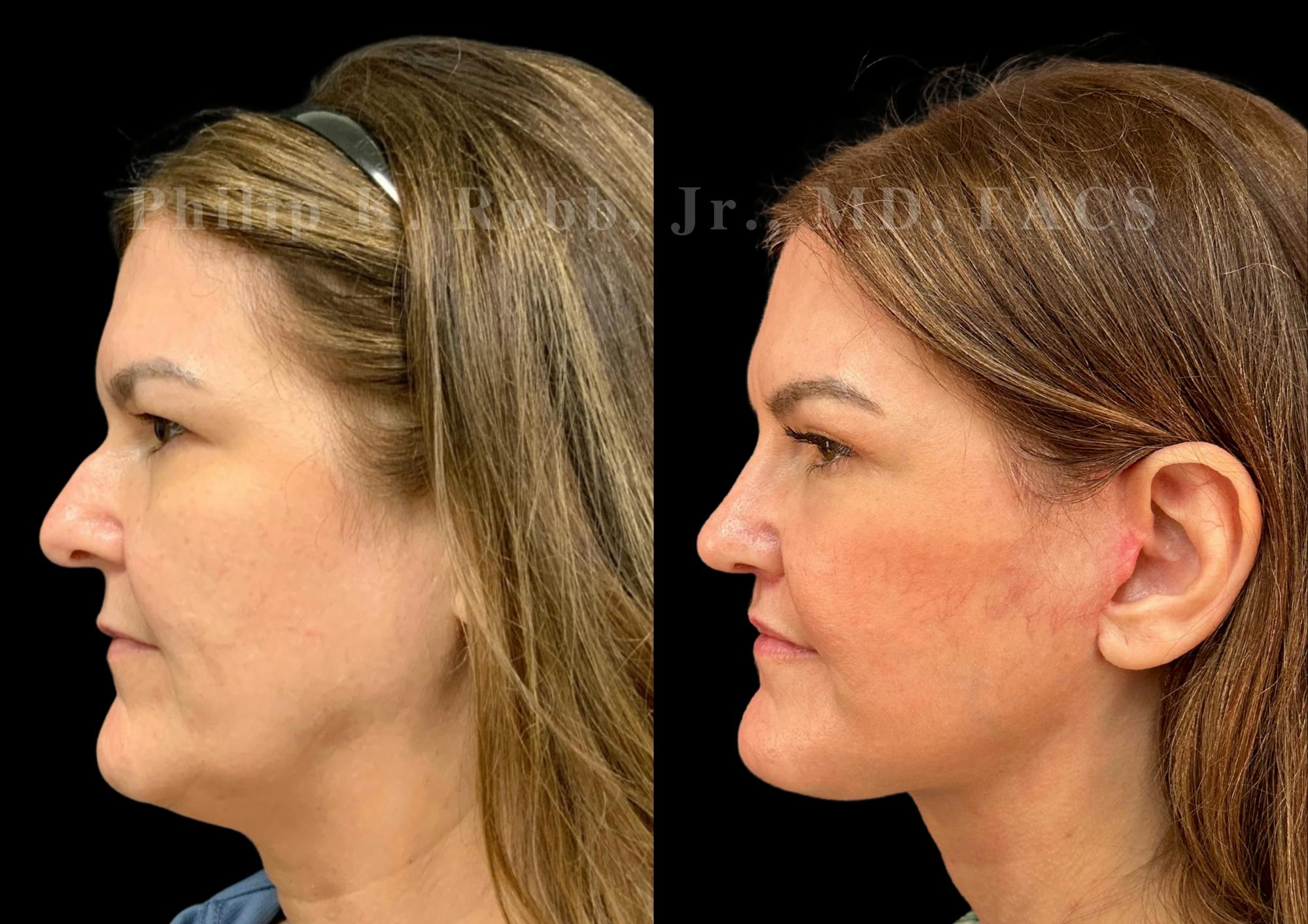 Facelift Before & After Gallery - Patient 145841 - Image 3