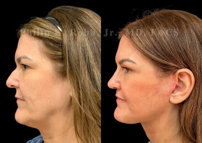 Neck Lift Before & After Gallery - Patient 294803 - Image 1