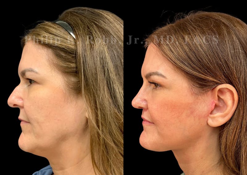 Neck Lift Before & After Gallery - Patient 294803 - Image 1