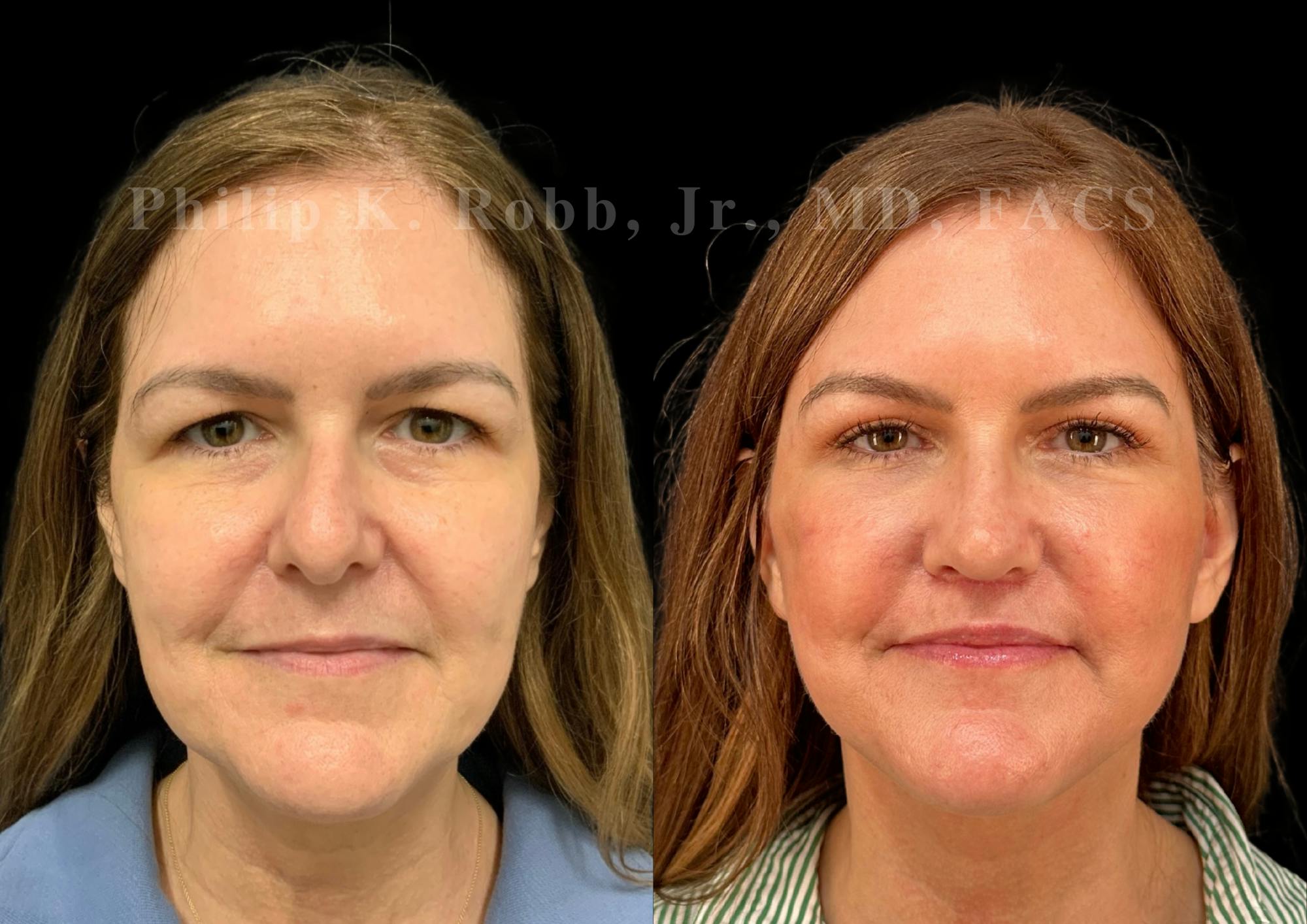 Facelift Before & After Gallery - Patient 145841 - Image 4