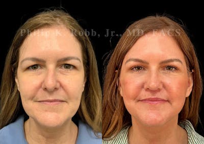 Upper Blepharoplasty Before & After Gallery - Patient 381062 - Image 1