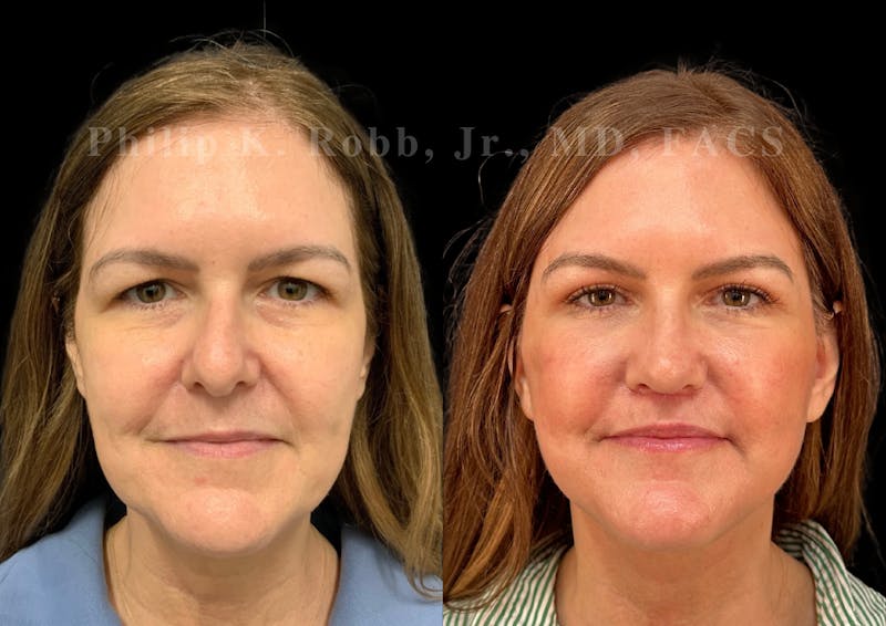 Neck Lift Before & After Gallery - Patient 294803 - Image 4