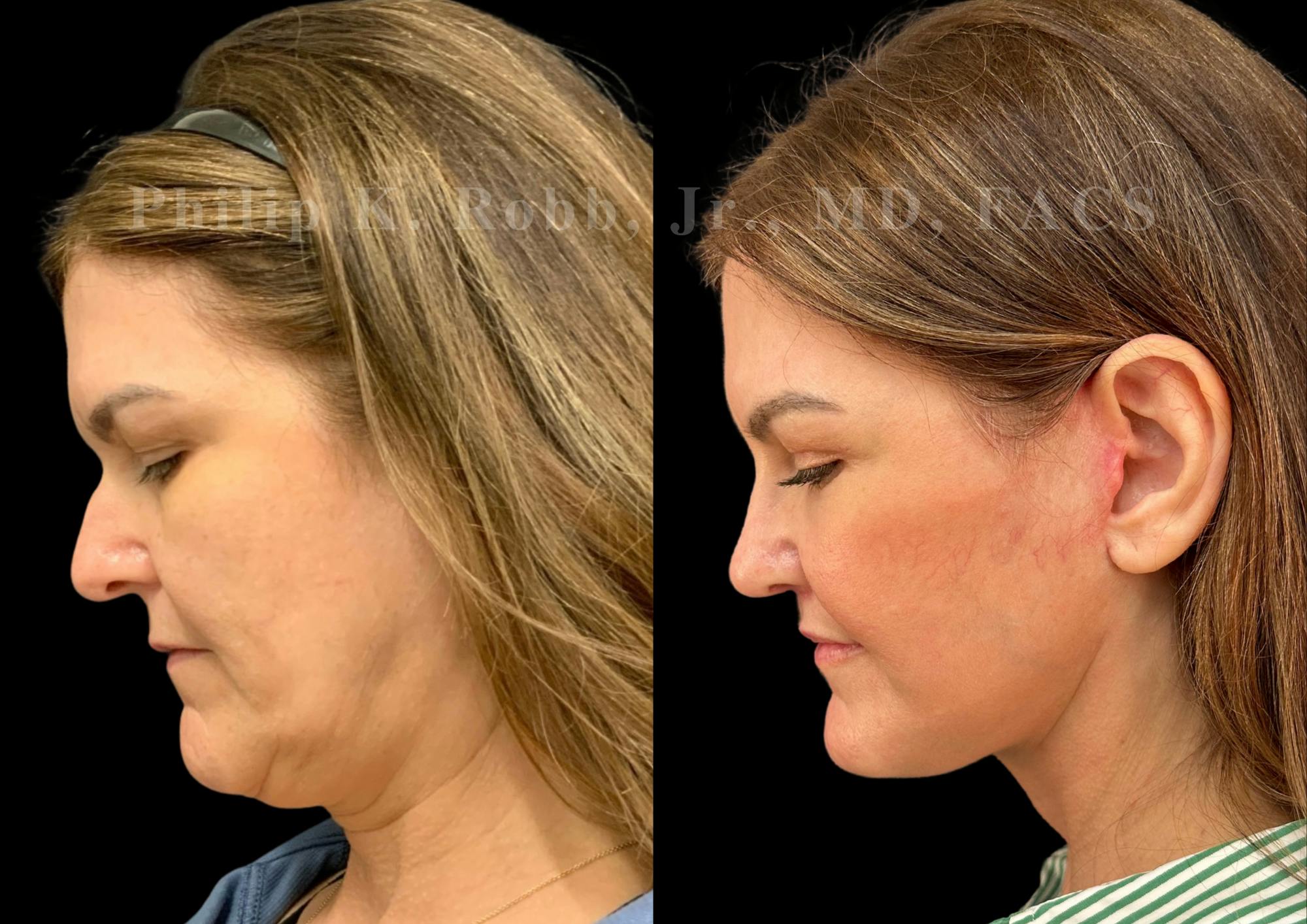 Facelift Before & After Gallery - Patient 145841 - Image 2