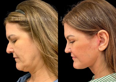 Neck Lift Before & After Gallery - Patient 294803 - Image 2