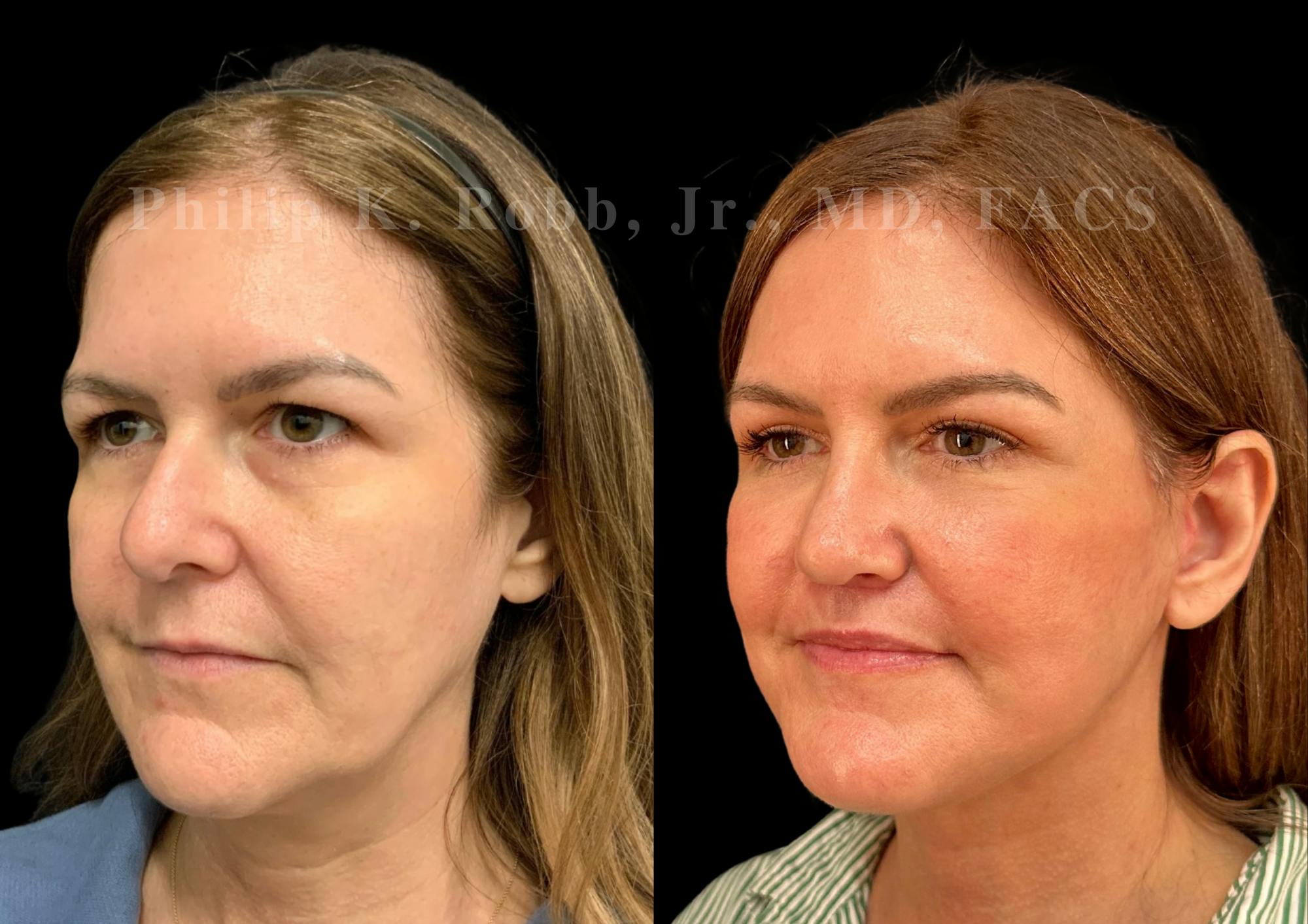 Facelift Before & After Gallery - Patient 145841 - Image 1