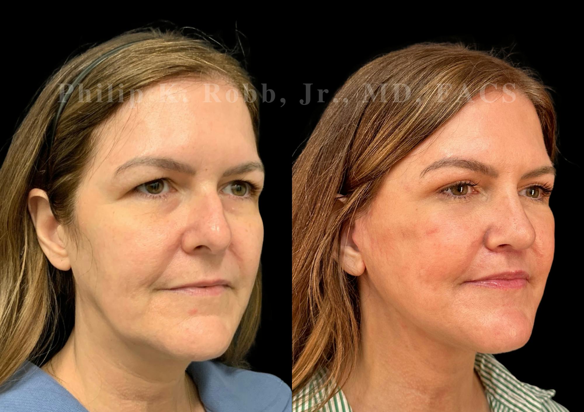 Facelift Before & After Gallery - Patient 145841 - Image 5