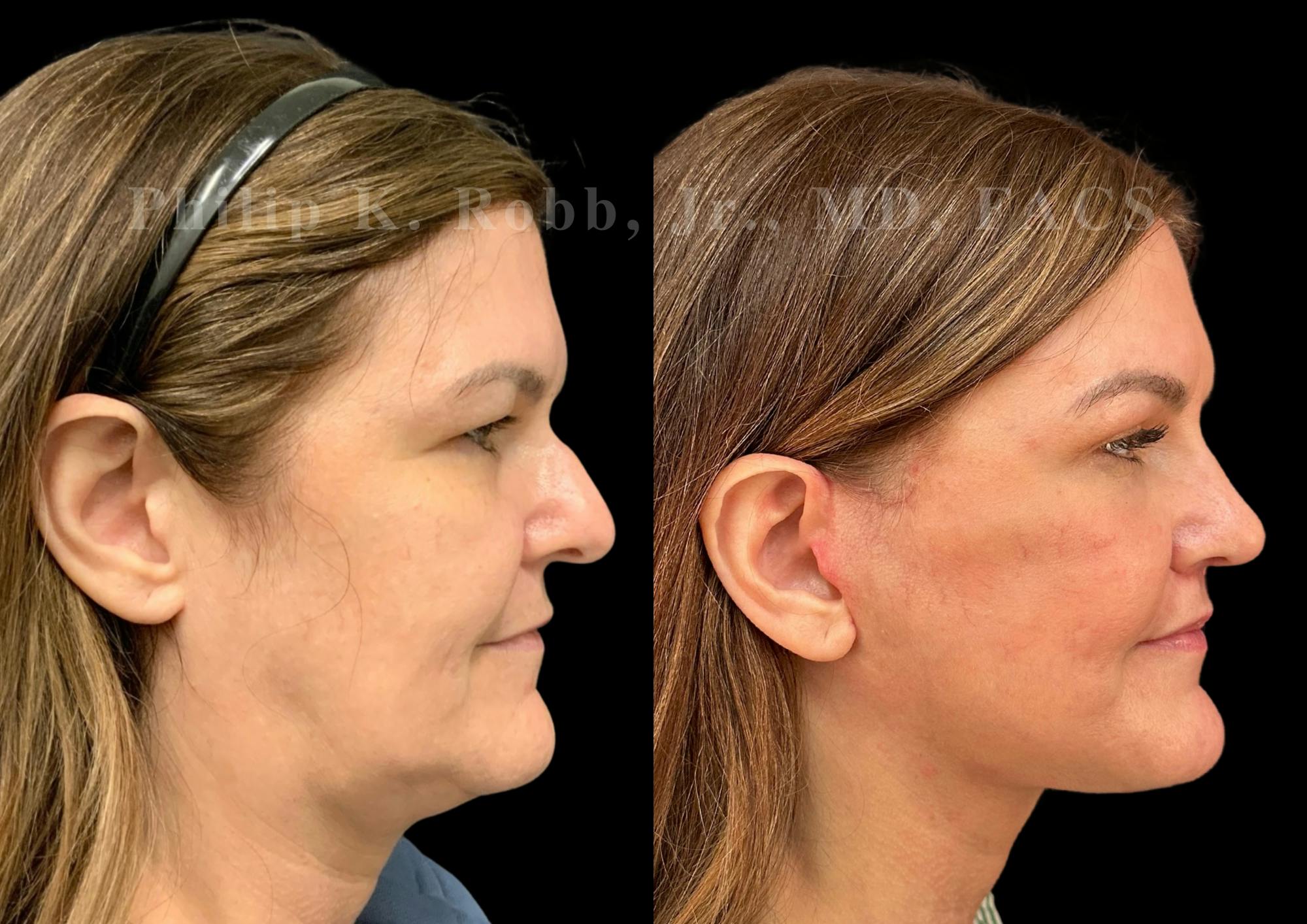 Facelift Before & After Gallery - Patient 145841 - Image 6