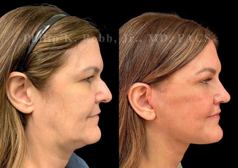 Neck Lift Before & After Gallery - Patient 294803 - Image 6