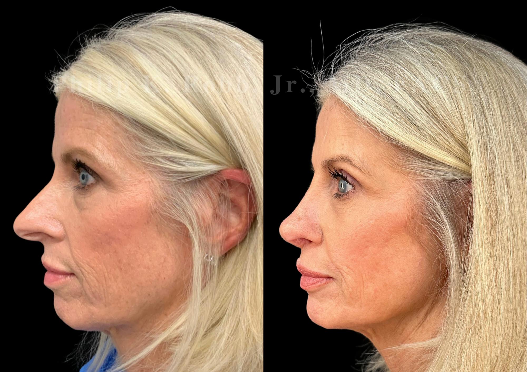Laser Skin Resurfacing Before & After Gallery - Patient 409282 - Image 2