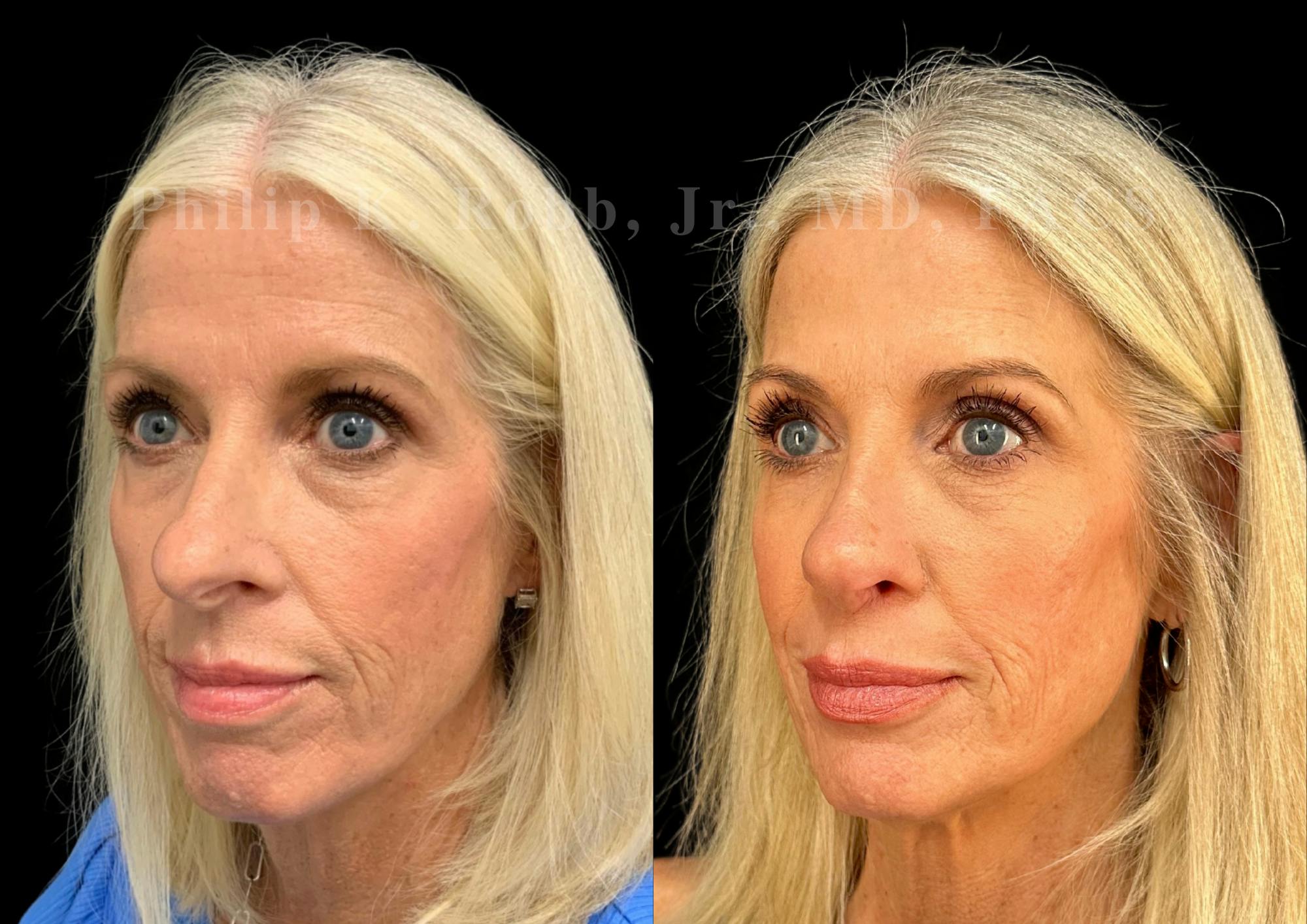 Laser Skin Resurfacing Before & After Gallery - Patient 409282 - Image 3